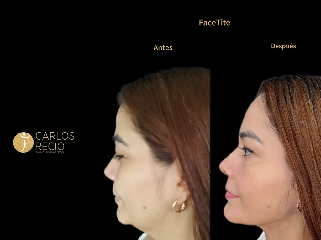 Deep Plane Facelift de Revisión: Cuando un Lifting Anterior No Dio el Resultado que Esperabas