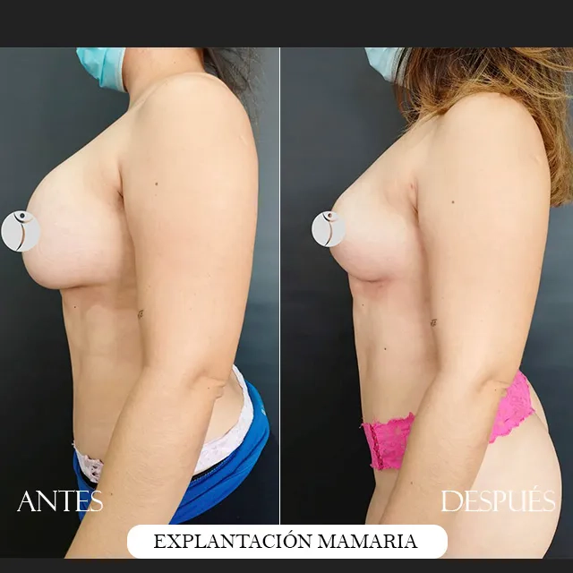 Explantacion mamaria (1) (1)