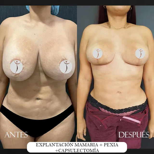 Explantacion mamaria (2) (2)