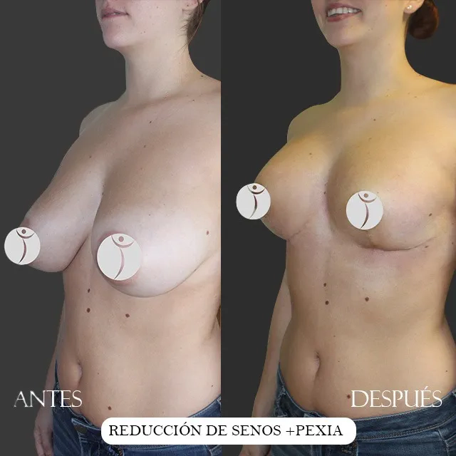 casos mamoplastia (3)