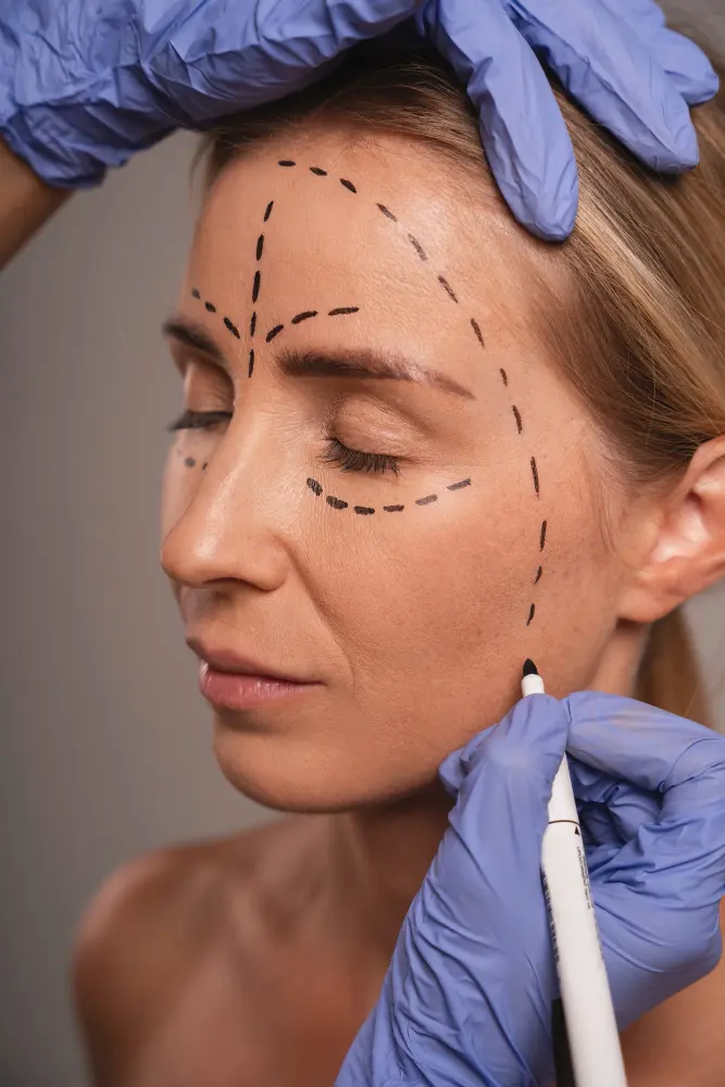 Lifting de cejas: cuando tu mirada dice algo que tú no sientes Frontoplastia (lifting frontal)