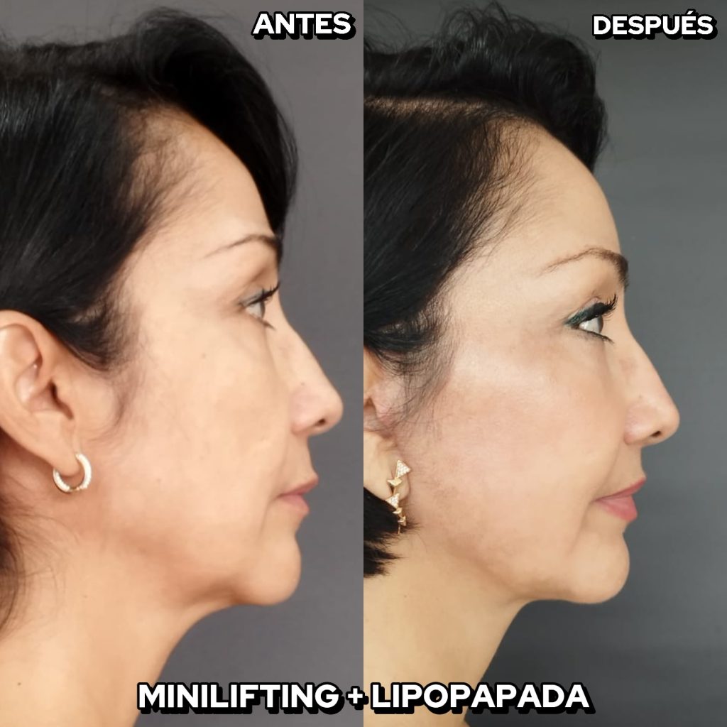 Mini-lifting facial: cómo rejuvenecer sin pasar por una cirugía mayor Mini-lifting facial: cómo rejuvenecer sin pasar por una cirugía mayor