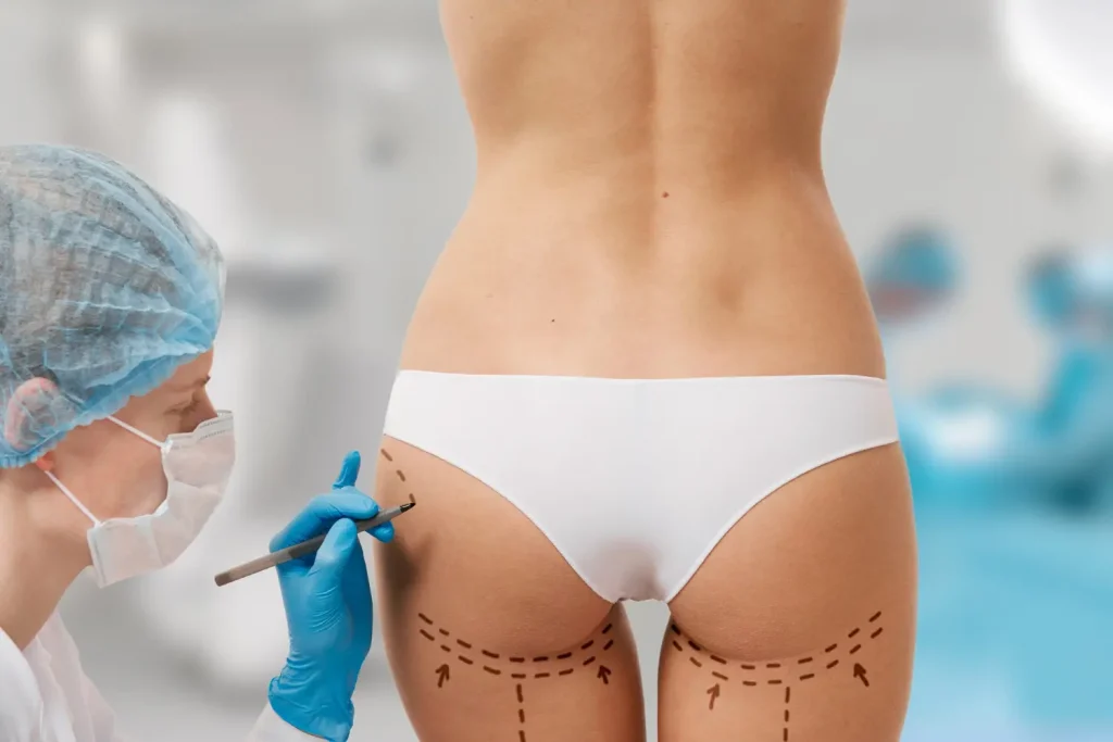 Lifting de glúteos sin implantes: firmeza y forma con un enfoque natural Lifting de glúteos sin implantes: firmeza y forma con un enfoque natural