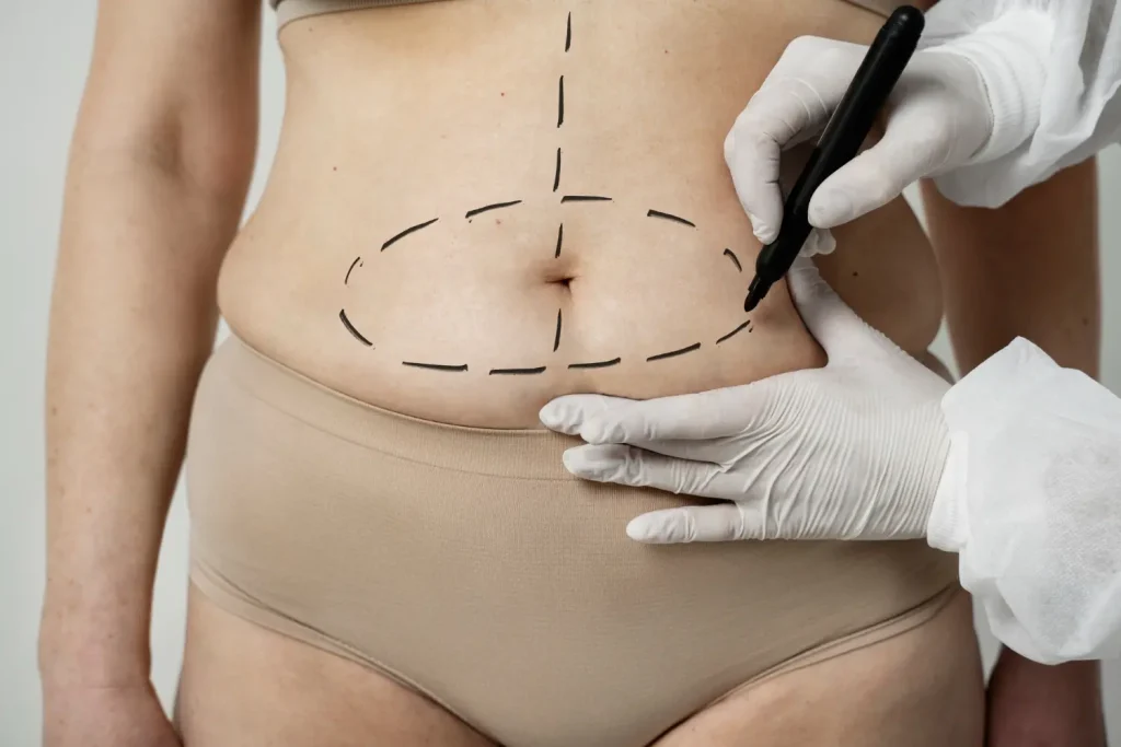 Abdominoplastia en Cali: guía completa, valoración y cómo agendar Abdominoplastia