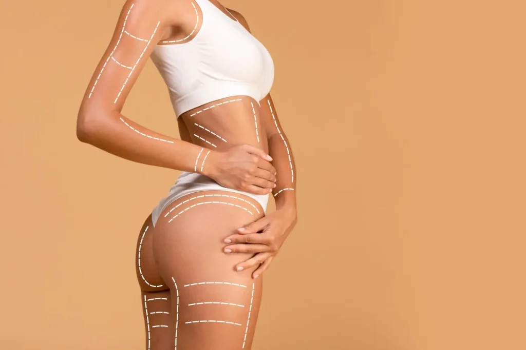 BodyTite: alternativa a la lipoescultura tradicional sin cirugía invasiva cirugia estetica lipo 360