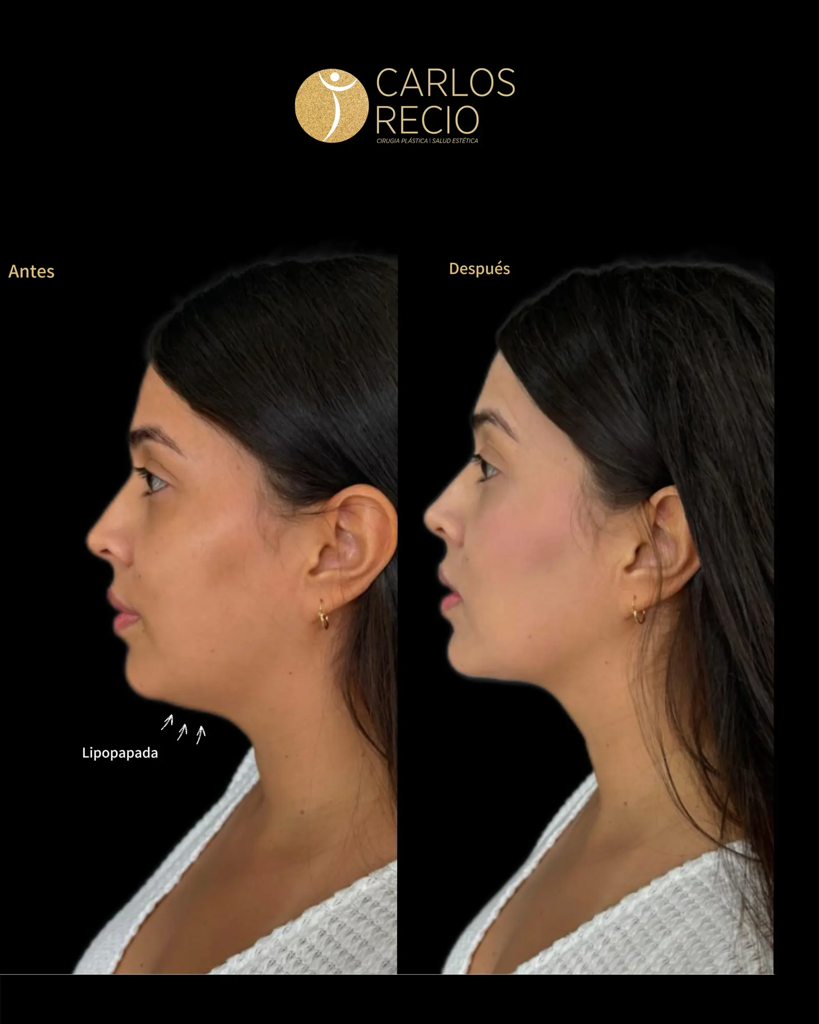 Armonización Facial Quirúrgica en Cali IMG_3400.webp