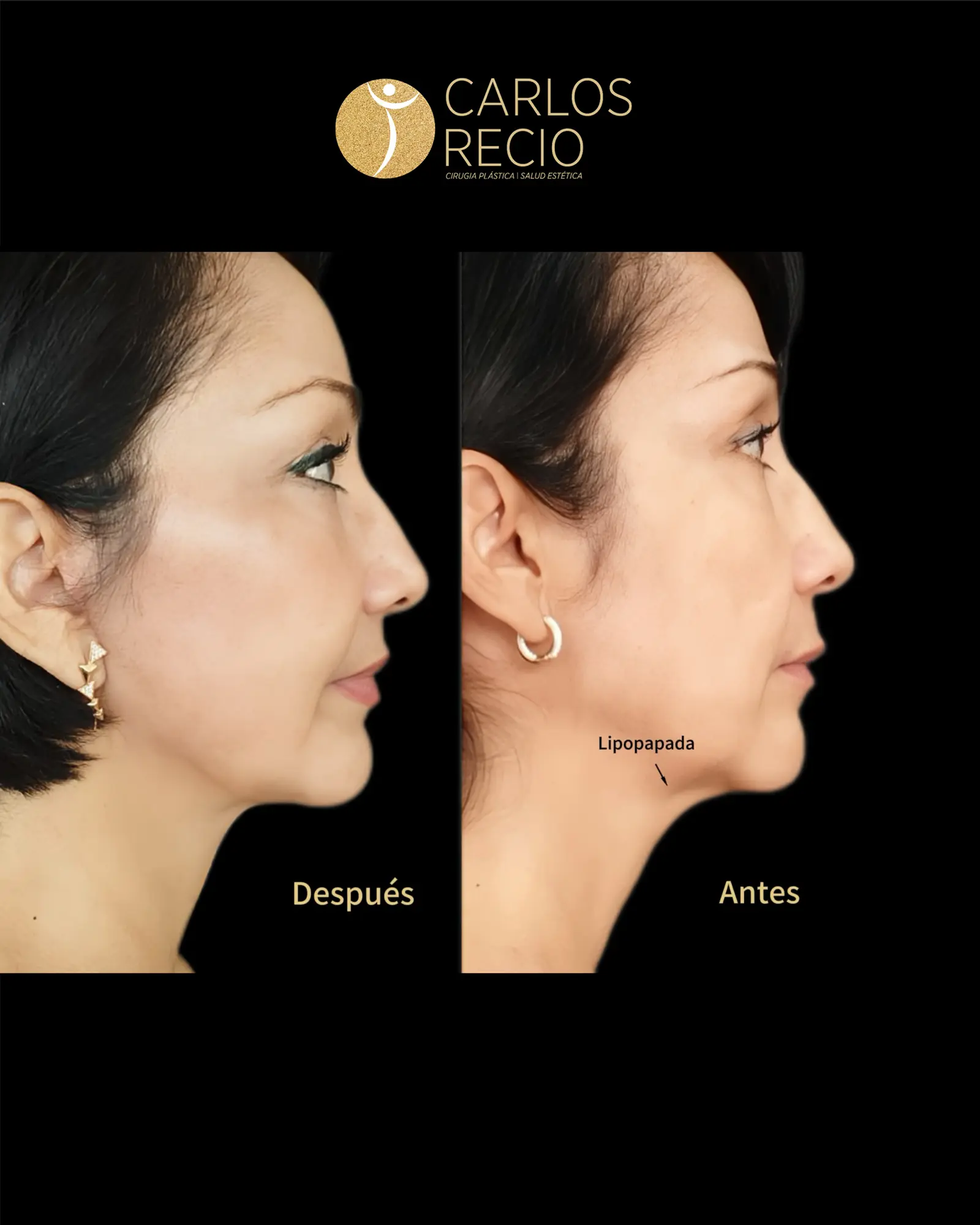 Armonización Facial Quirúrgica en Cali IMG_3405.webp