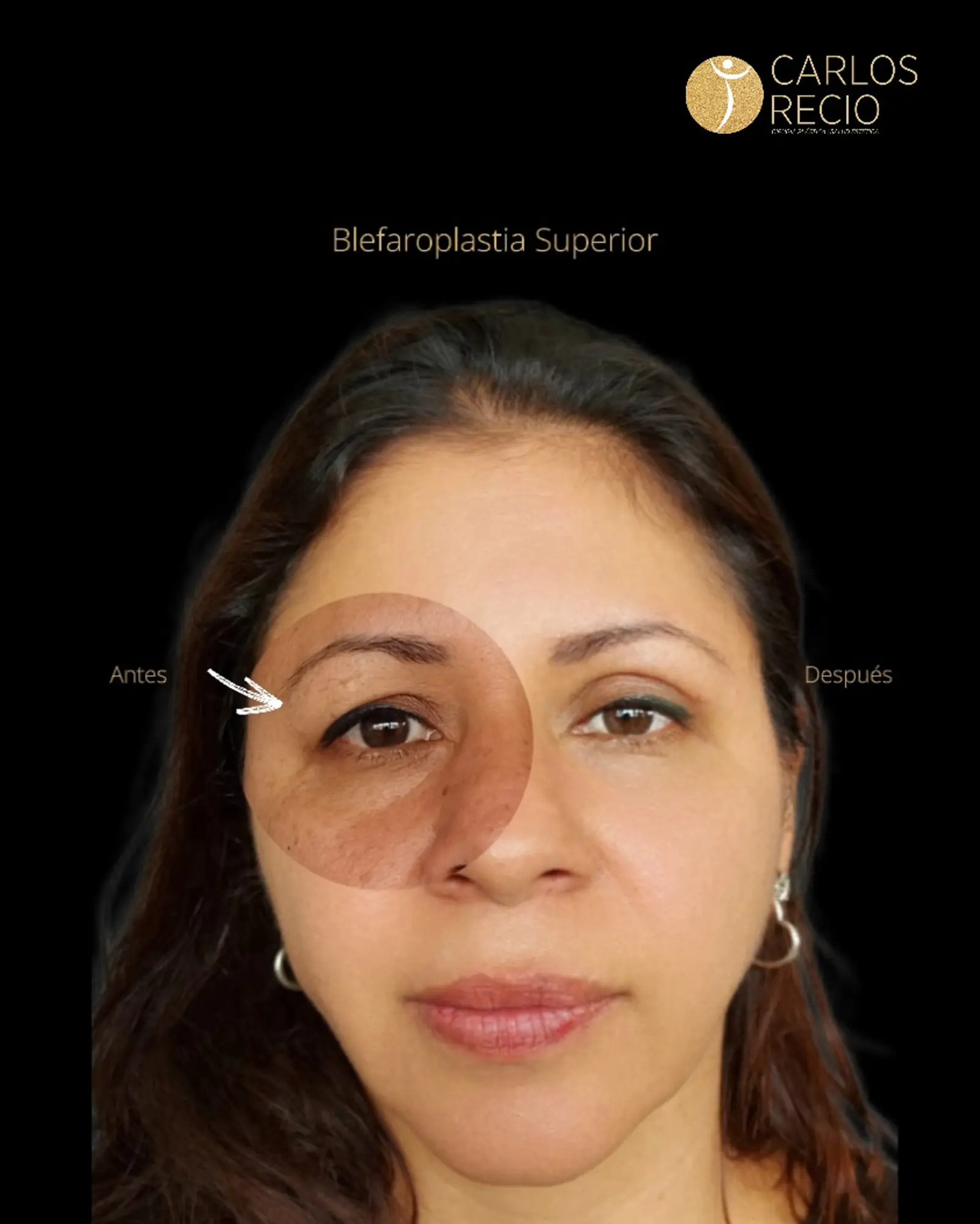 Armonización Facial Quirúrgica en Cali Armonización Facial
