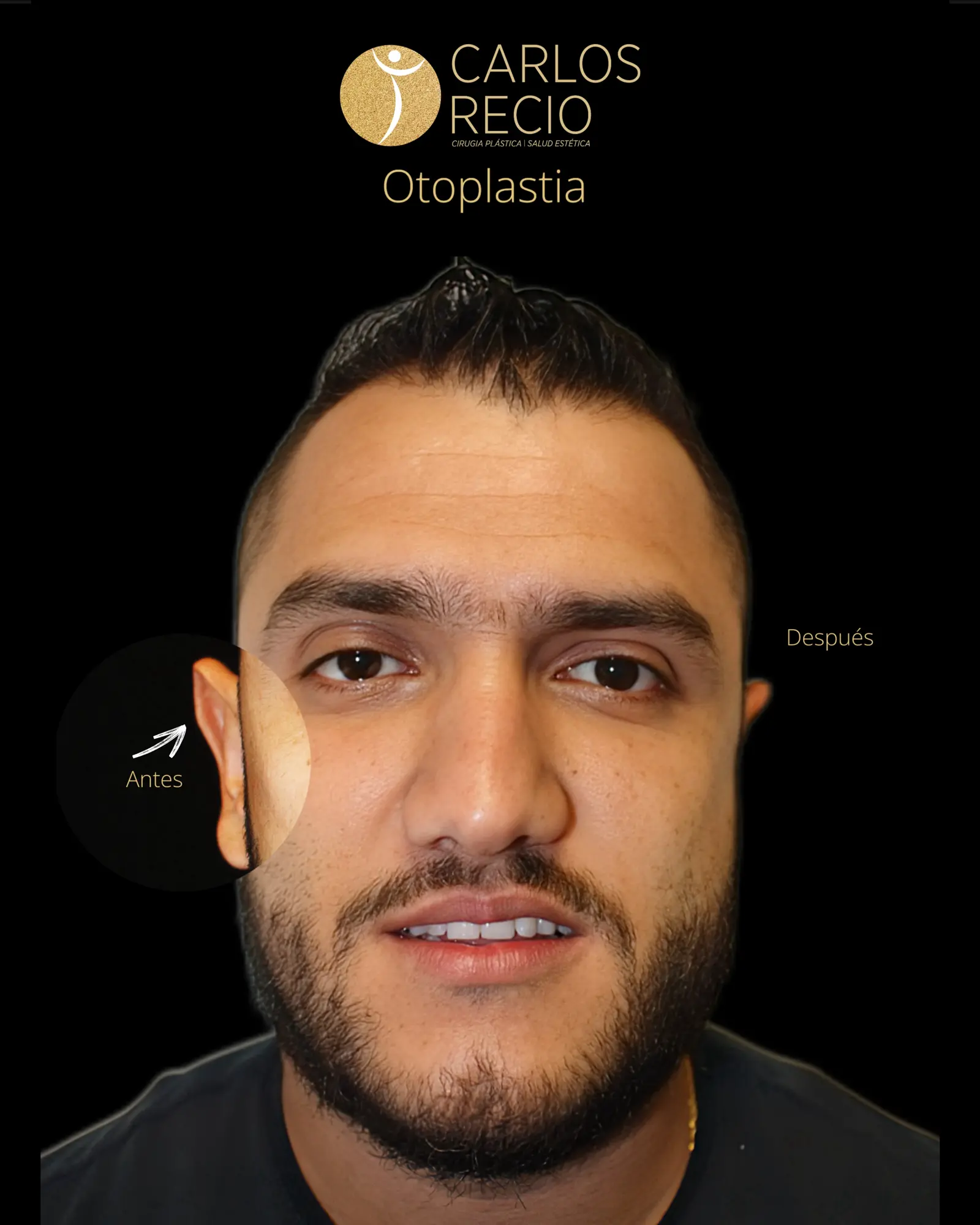 Cirugia de Oreja - Otoplastia IMG_3410 (1)