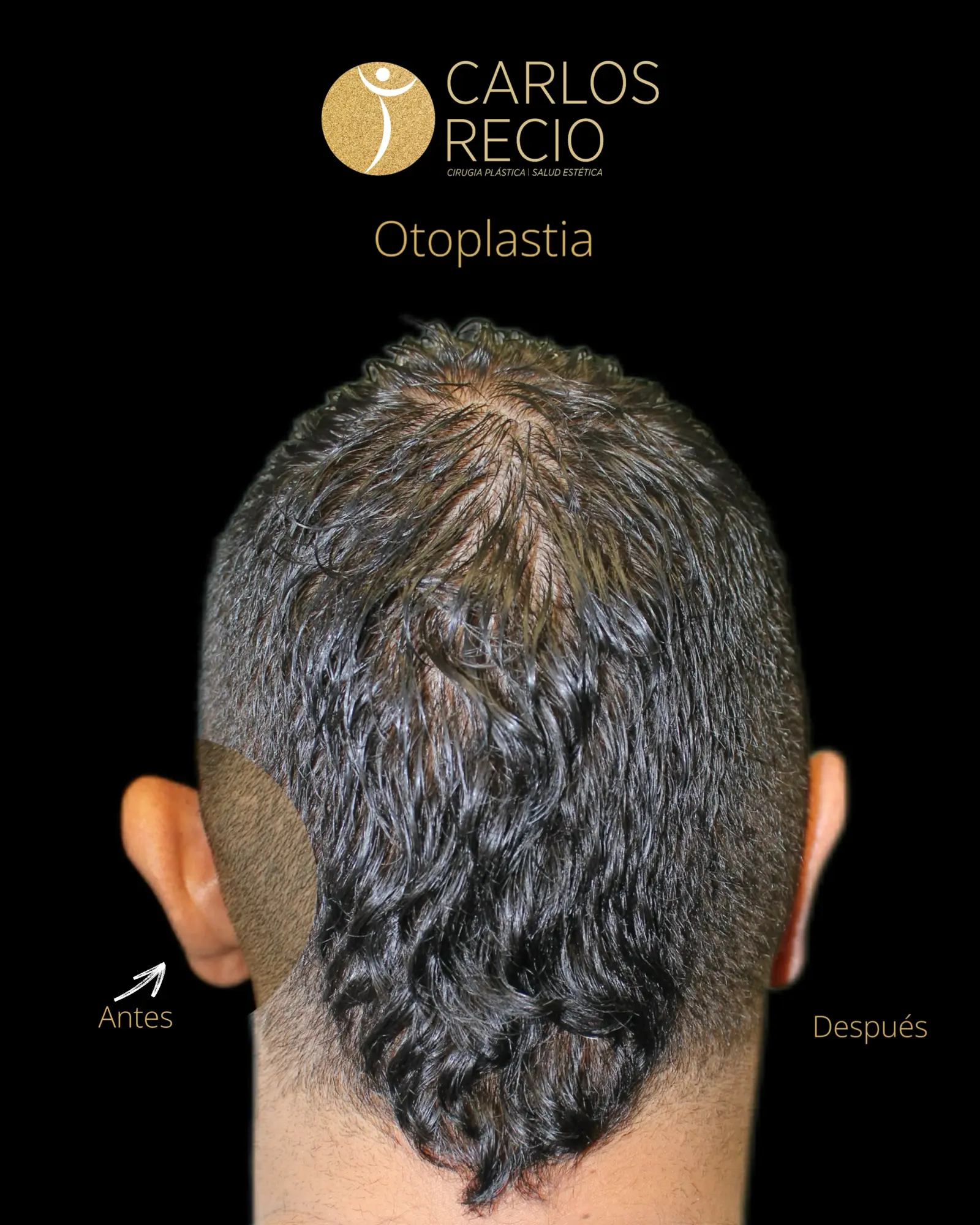 Cirugia de Oreja - Otoplastia IMG_3411 (1)