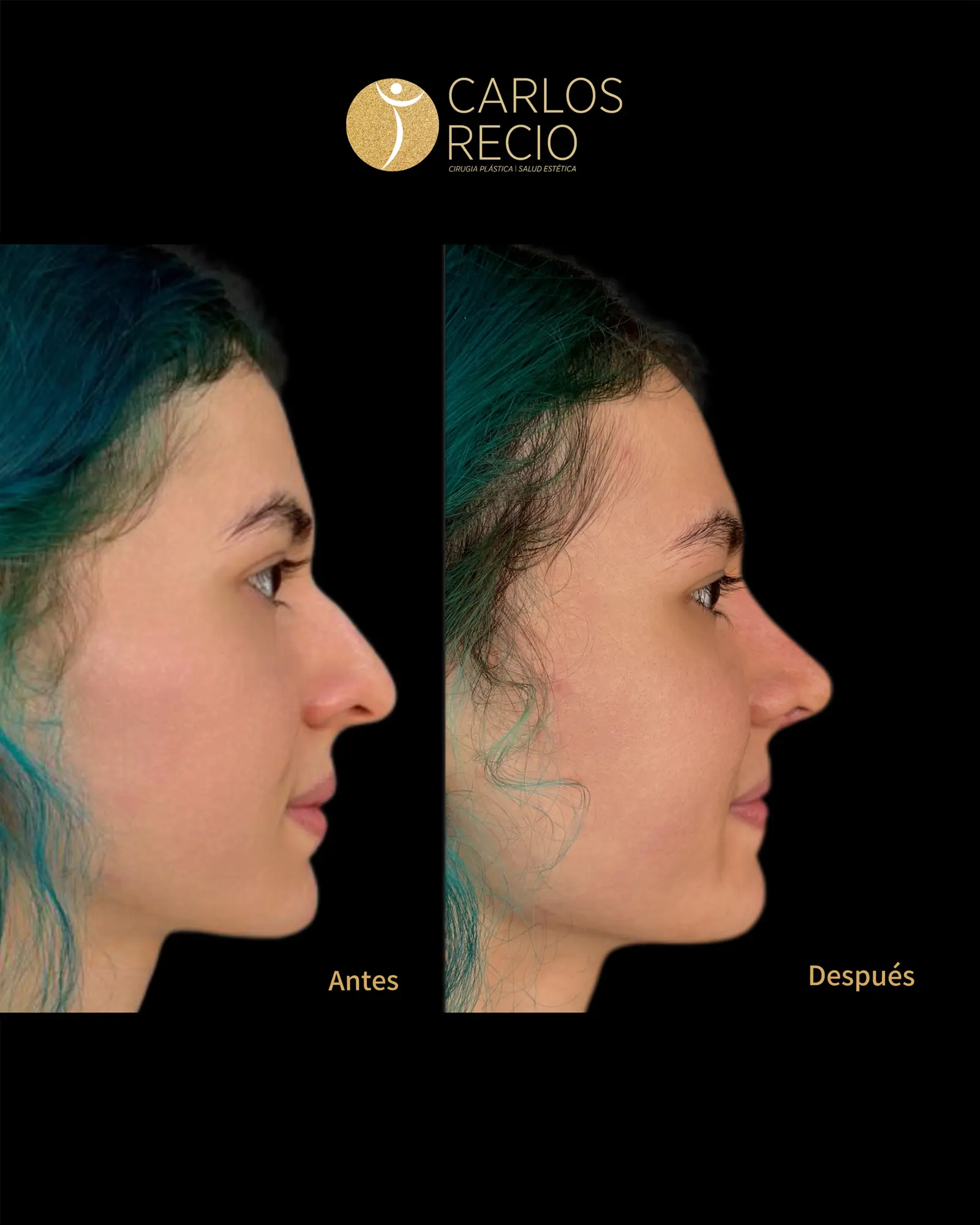 Armonización Facial Quirúrgica en Cali IMG_3412.webp