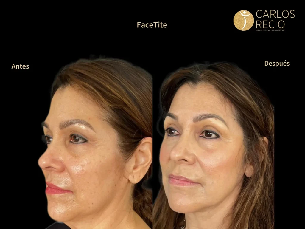 Deep Plane Facelift: Recuperación Día a Día, Qué Esperar en Cada Semana Lifting Facial Deep Plane