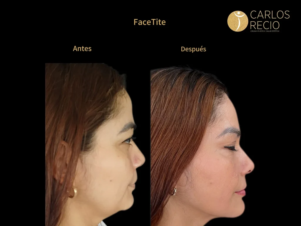 Deep Plane Facelift: Recuperación Día a Día, Qué Esperar en Cada Semana Lifting Facial Deep Plane