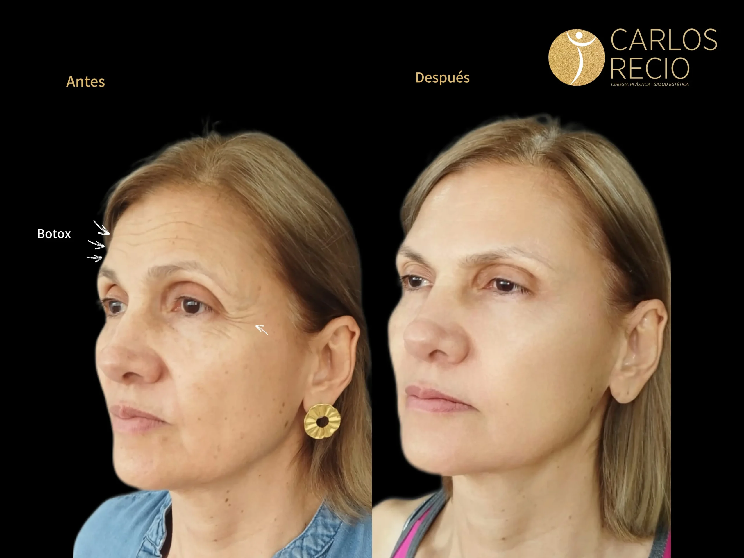 Inyectables No Quirúrgicos Inyectables No Quirúrgicos