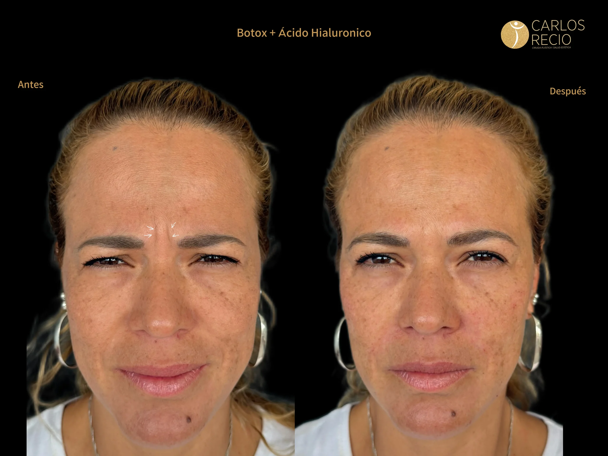 Inyectables No Quirúrgicos Inyectables No Quirúrgicos