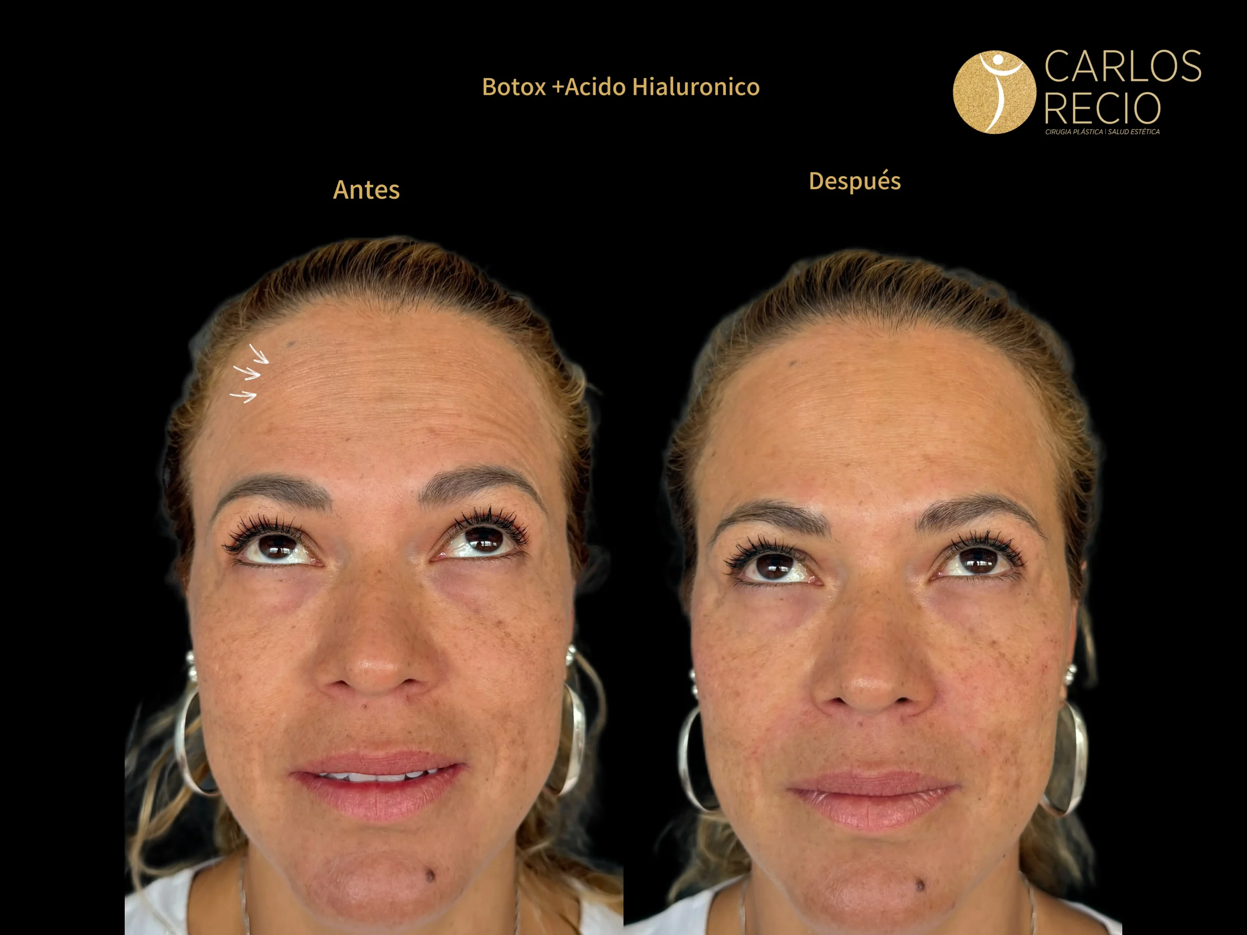 Inyectables No Quirúrgicos Inyectables No Quirúrgicos