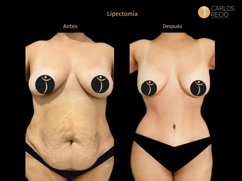 Lipectomía: cuándo la piel sobrante ya no se resuelve con liposucción Lipectomía: cuándo la piel sobrante ya no se resuelve con liposucción