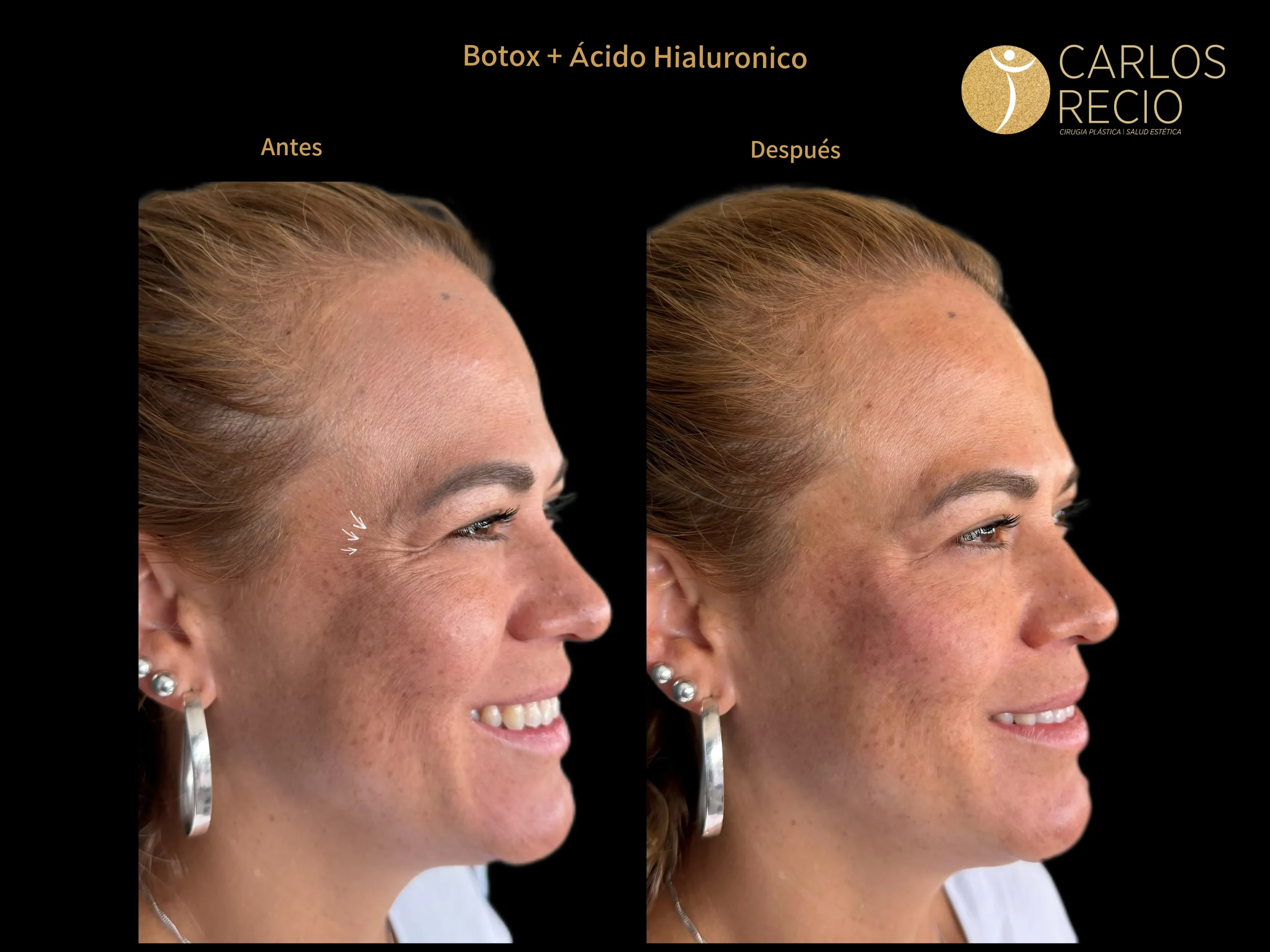 procedimientos faciales en Cali BOTOX