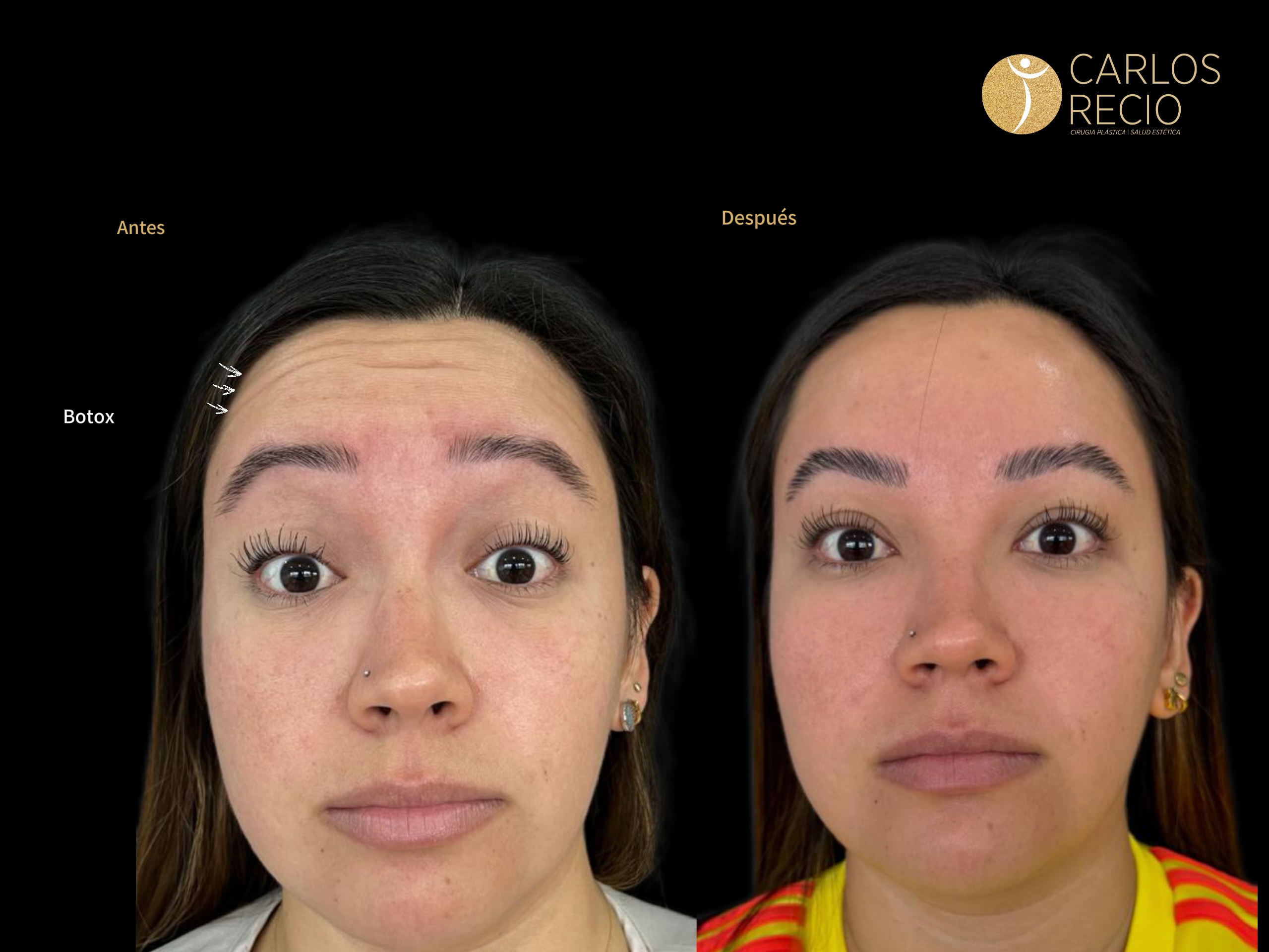 procedimientos faciales en Cali BOTOX