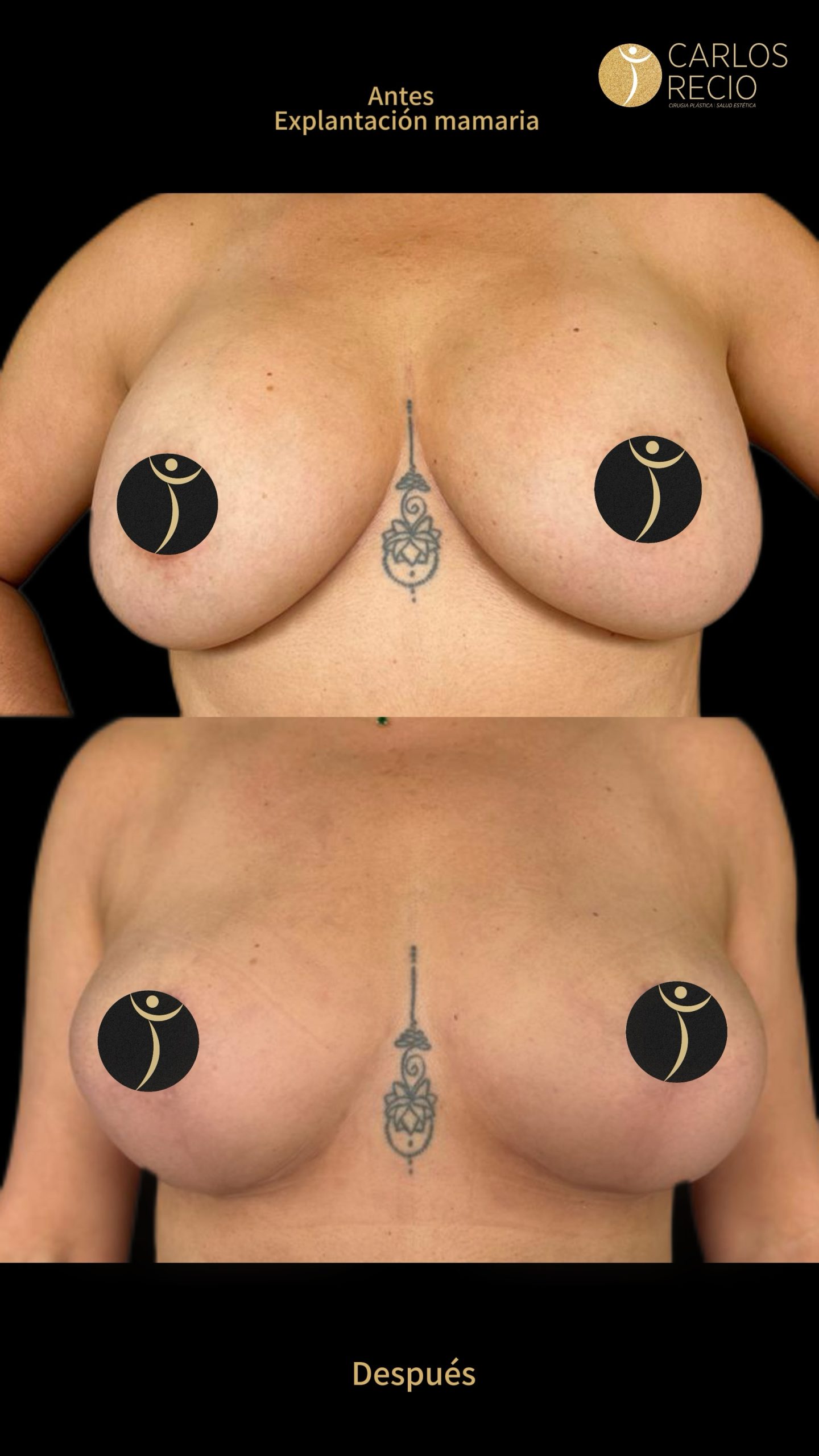 Explantación Mamaria en Cali Copia de Explantacion