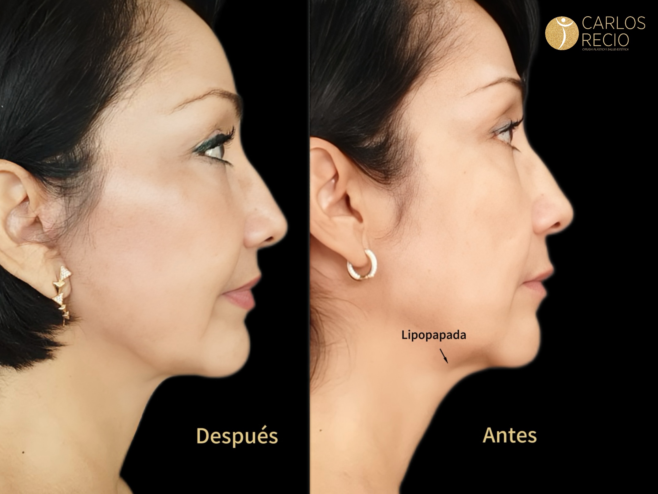Liposucción de papada - Lipo-Papada Copia de IMG_3405