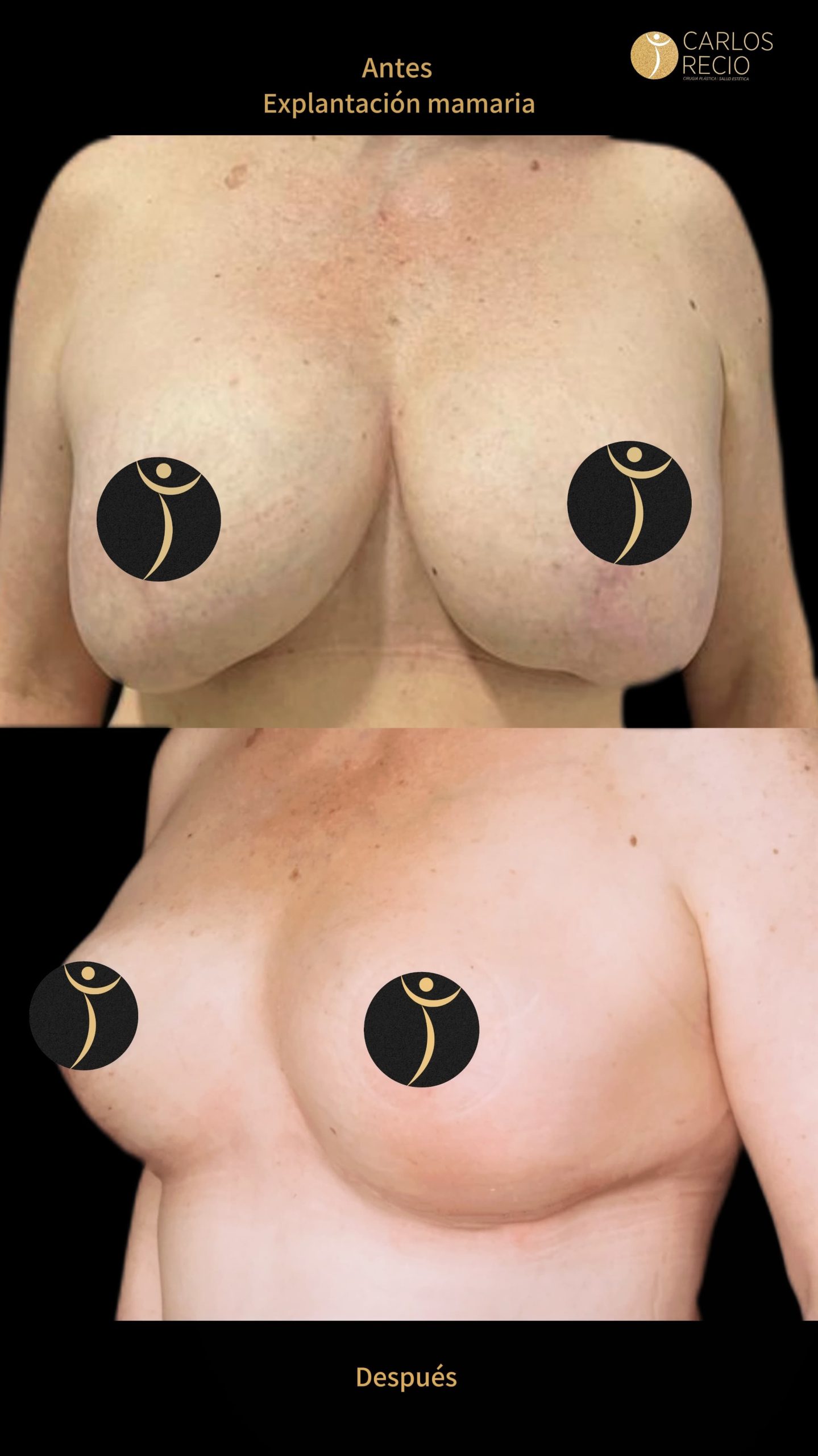 Explantación Mamaria en Cali Copia de IMG_3435