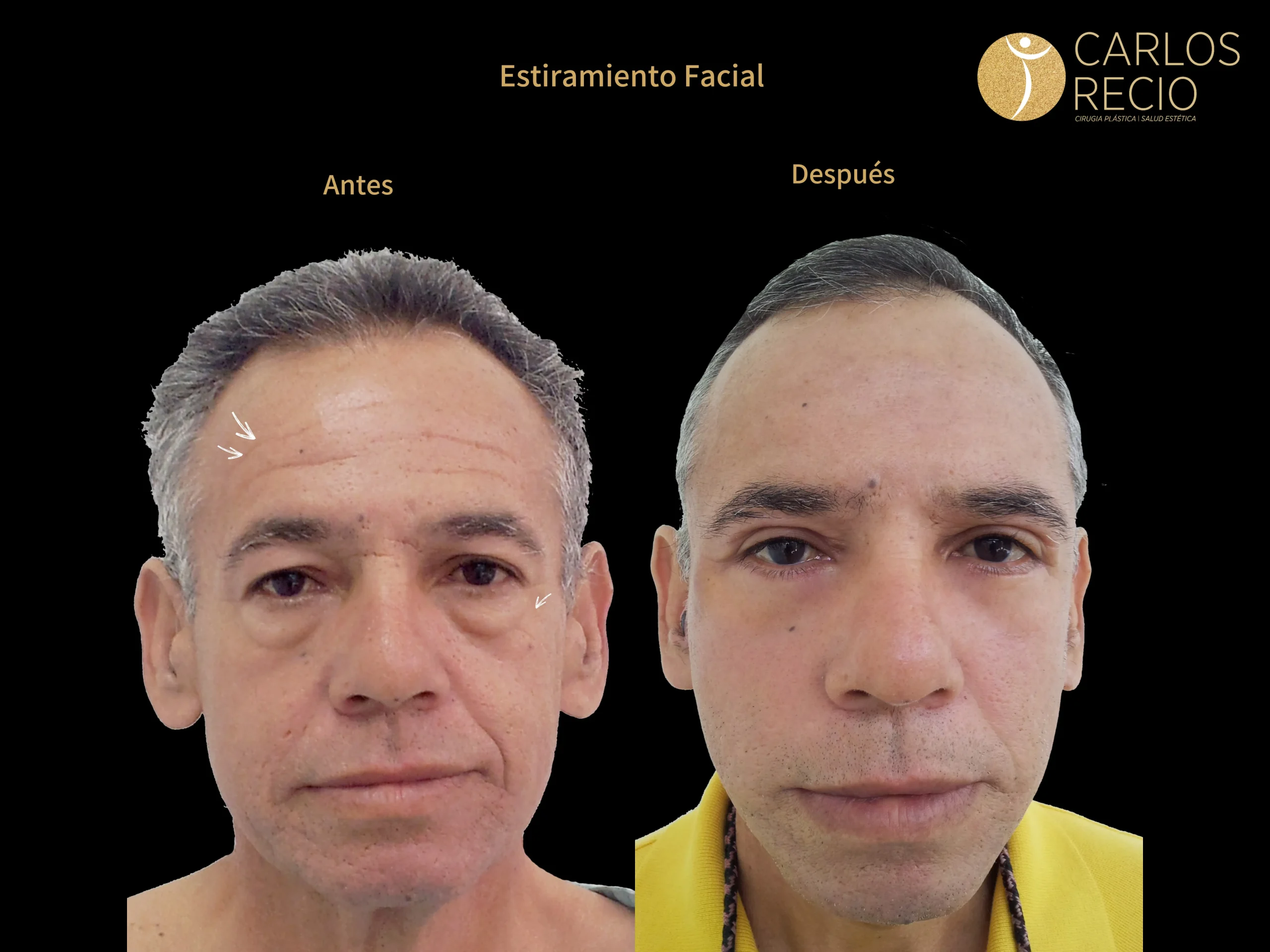 procedimientos faciales en Cali ESTIRAMIENTO FACIAL
