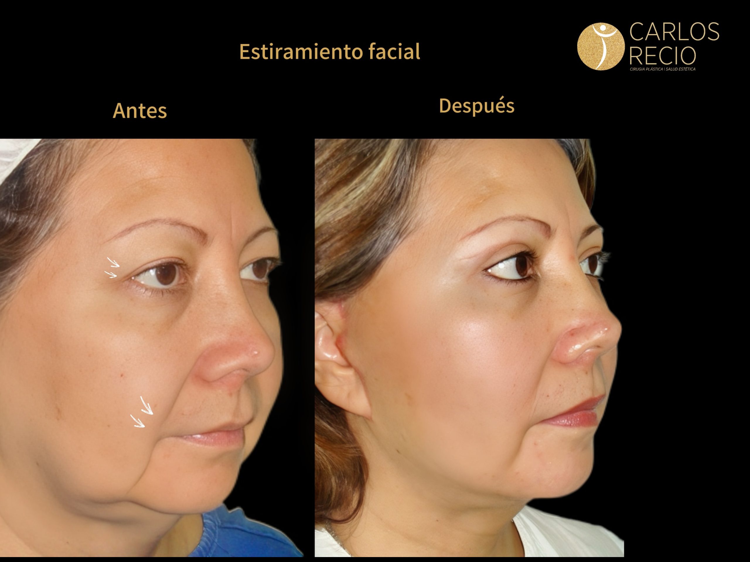 procedimientos faciales en Cali MENTOPLASTIA