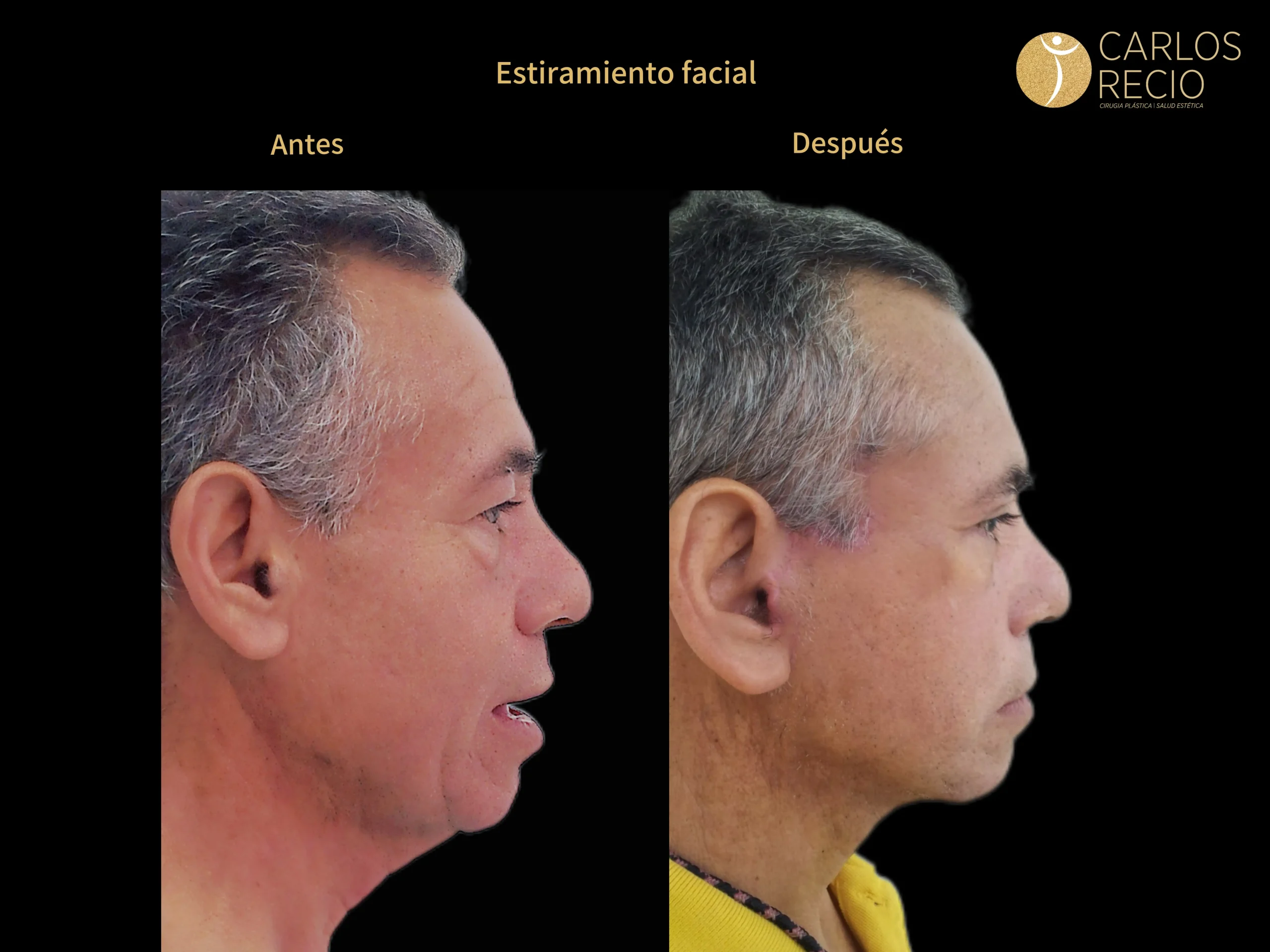 Procedimientos para Hombres en Cali ESTIRAMIENTO FACIALJPG(1)