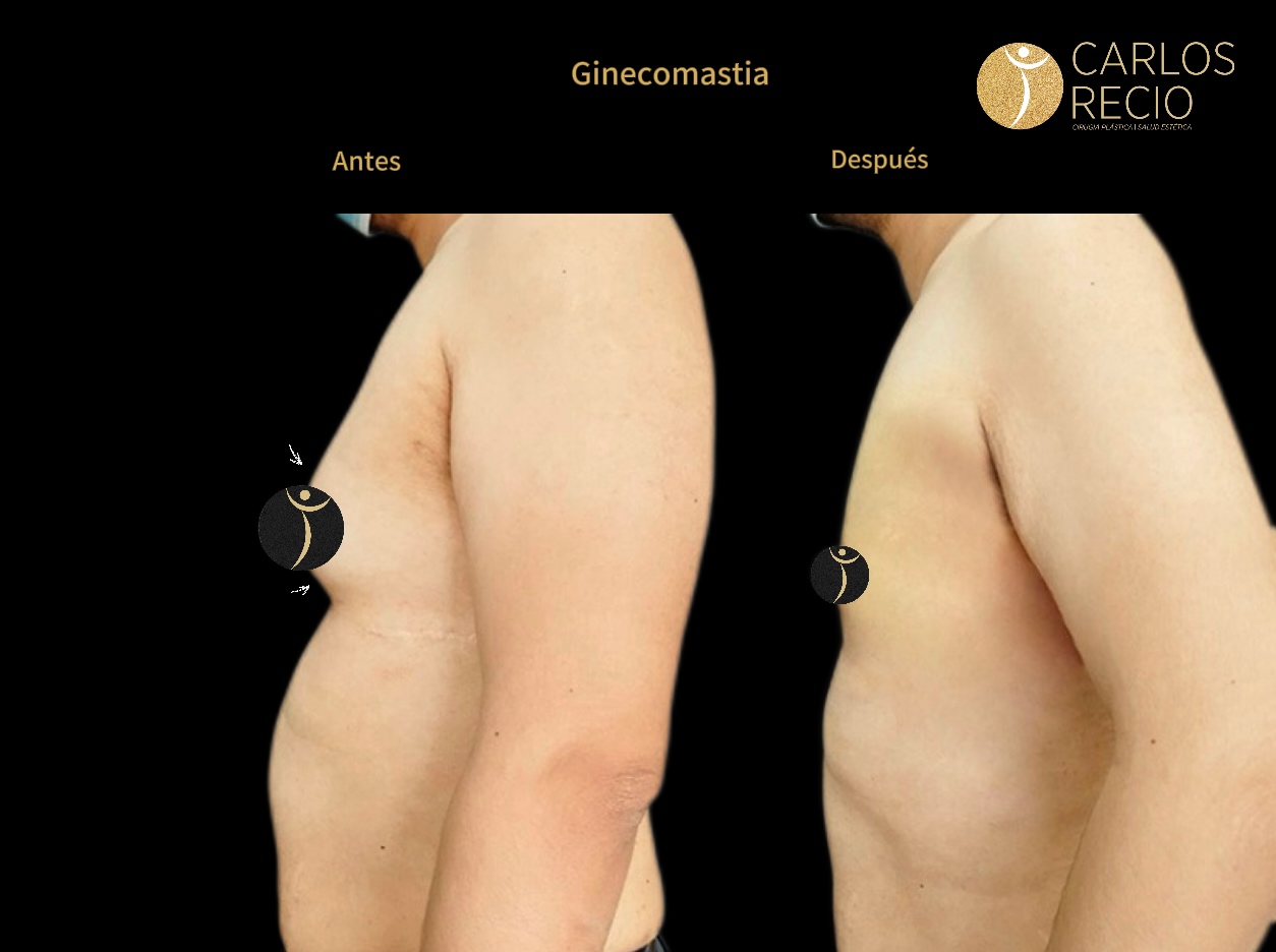 Procedimientos para Hombres en Cali GINECOMASTIA JPG