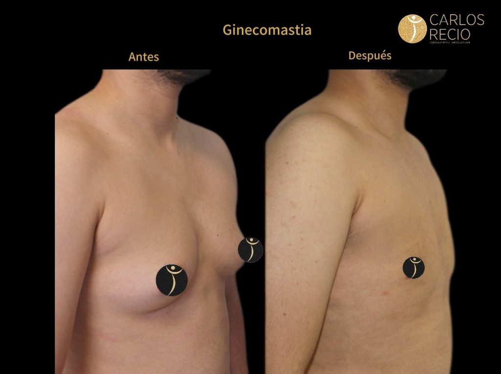 Ginecomastia en Cali: precio de la cirugía para hombres con el Dr. Carlos Recio
