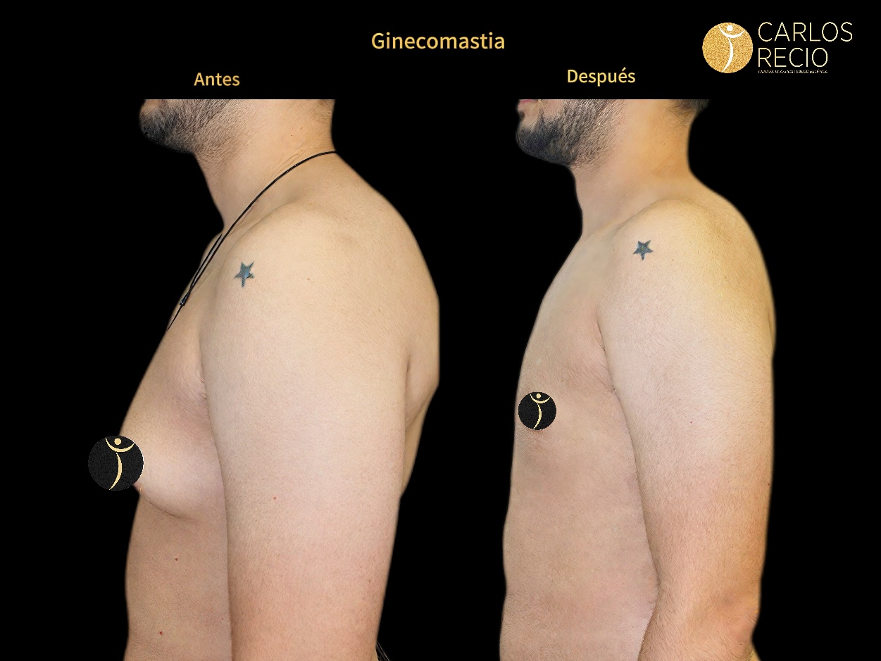 Procedimientos para Hombres en Cali GINECOMASTIAJPG(1)