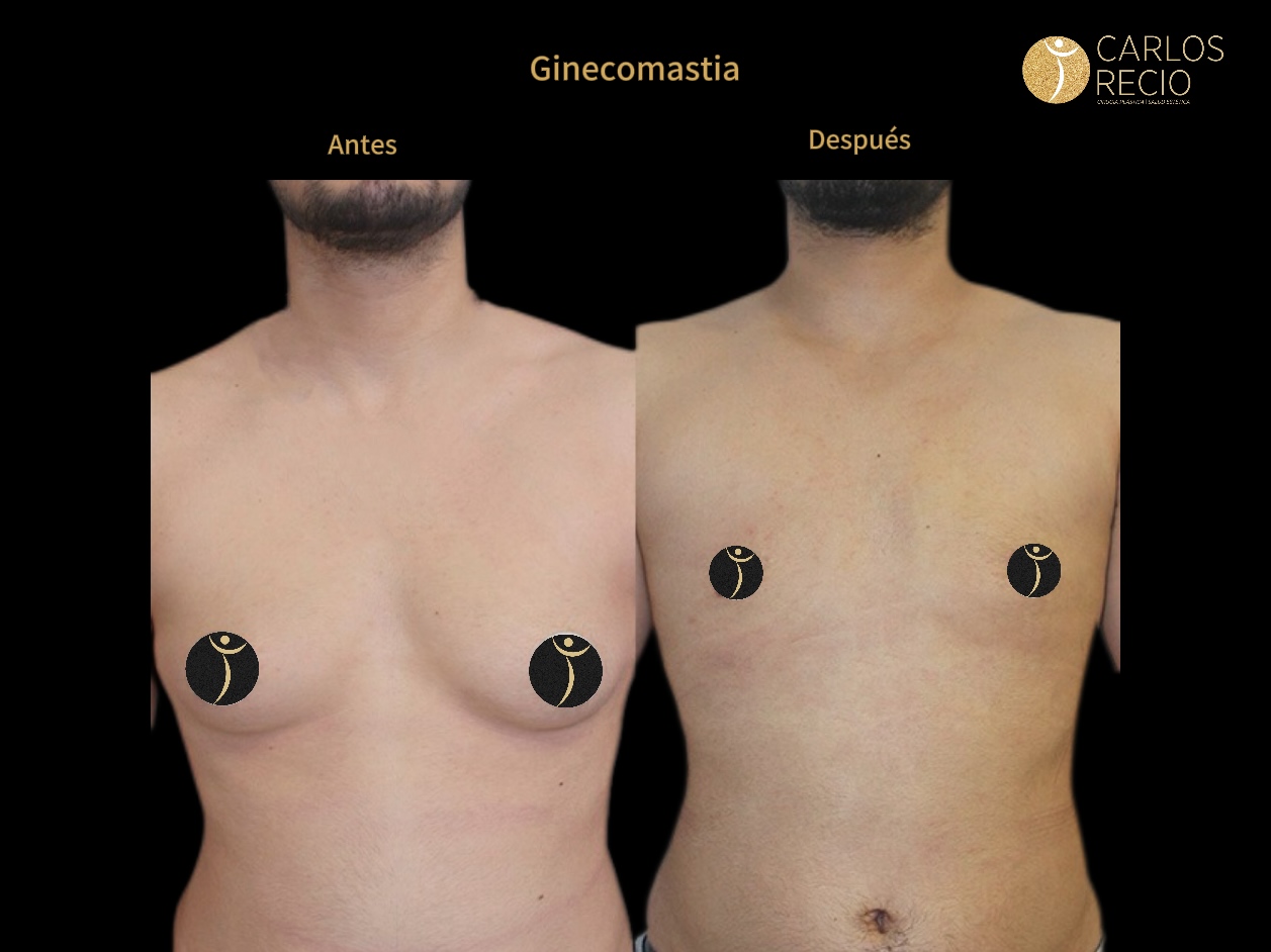 Procedimientos para Hombres en Cali ginecomastia