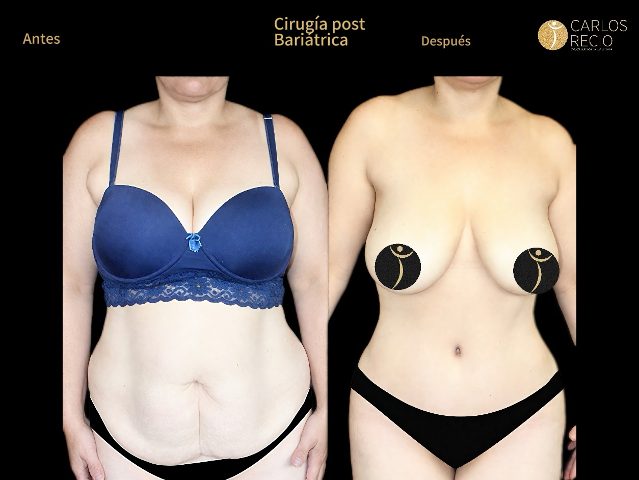 Cirugia reconstructiva post bariatrica IMG_3577
