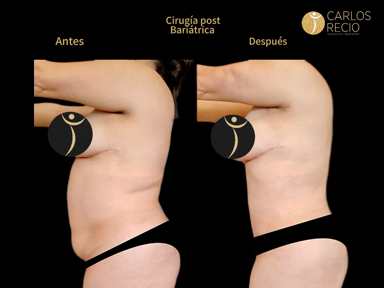 Cirugia reconstructiva post bariatrica IMG_3586