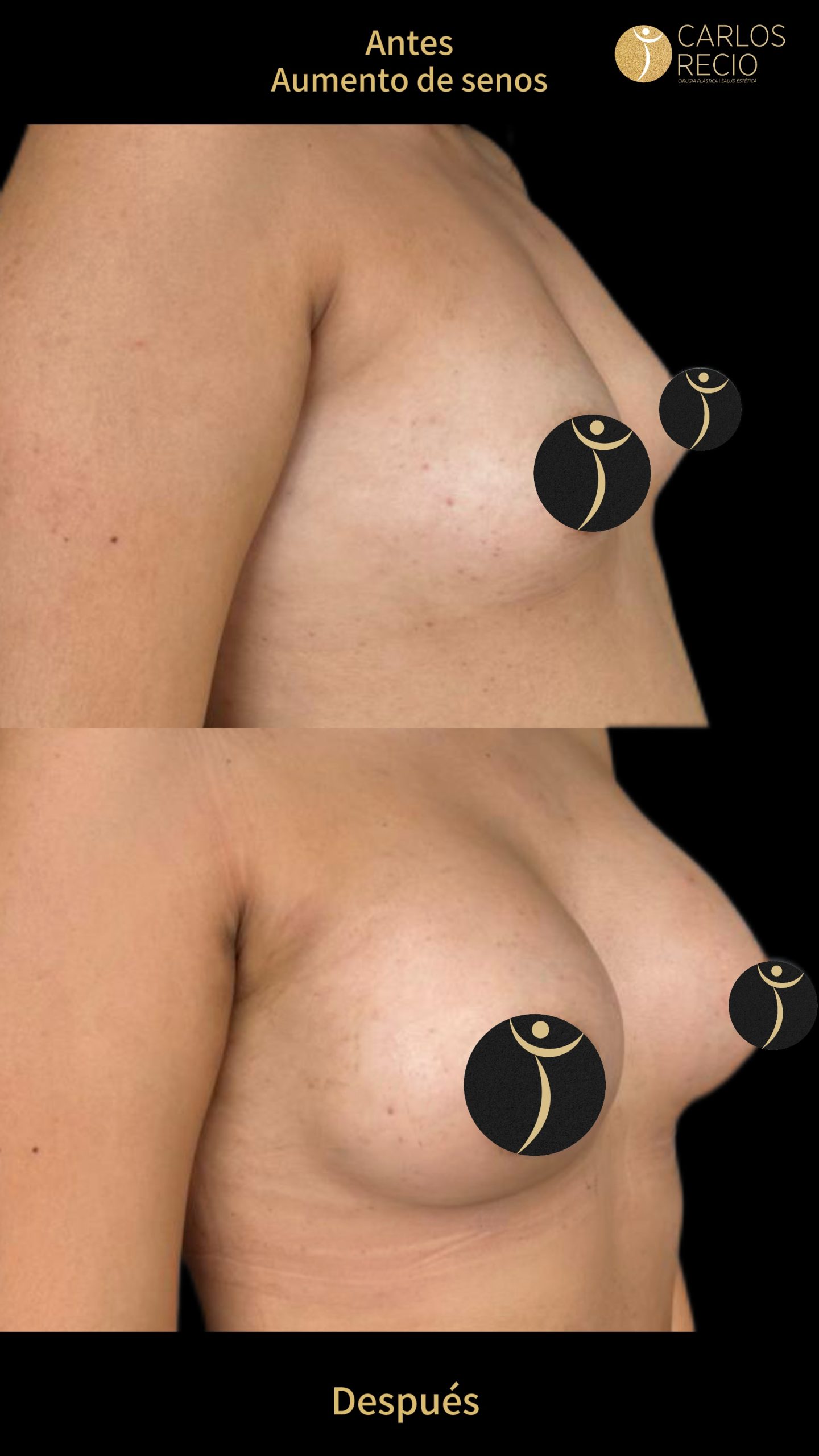 Aumento de senos en Cali IMG_3588