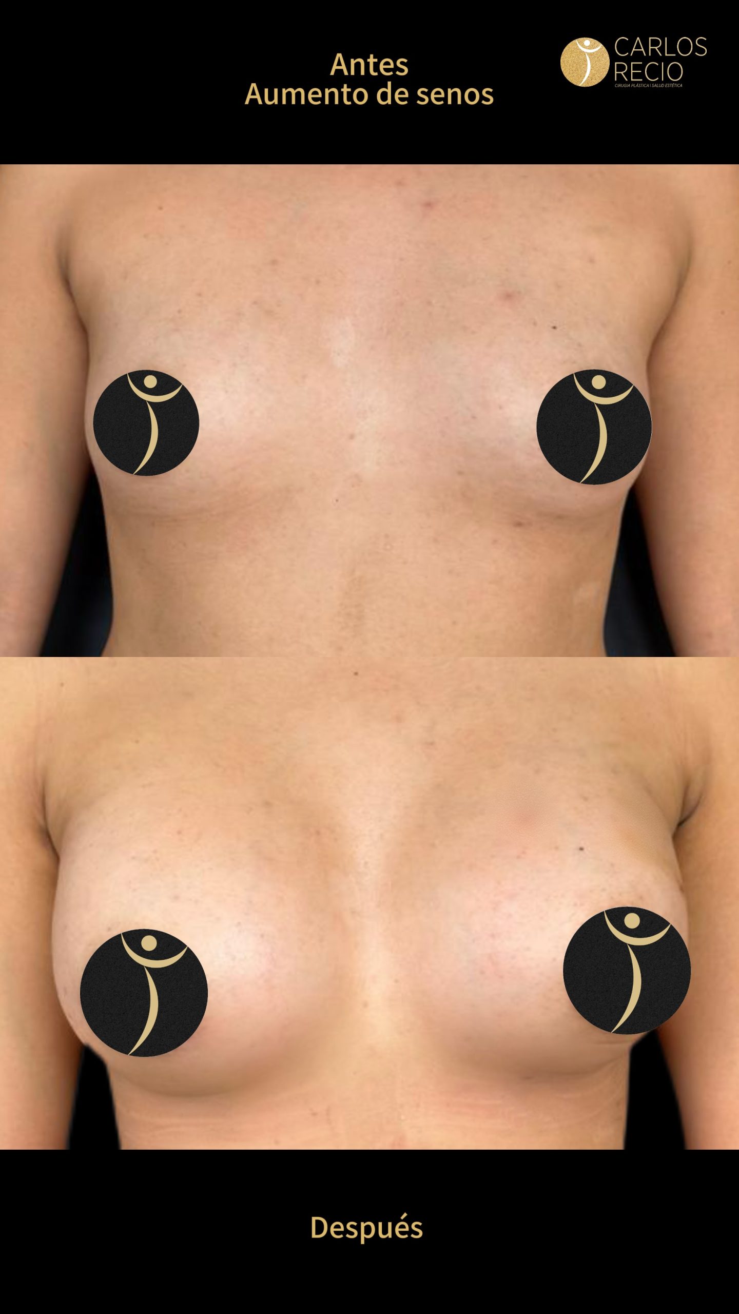 Aumento de senos en Cali IMG_3590