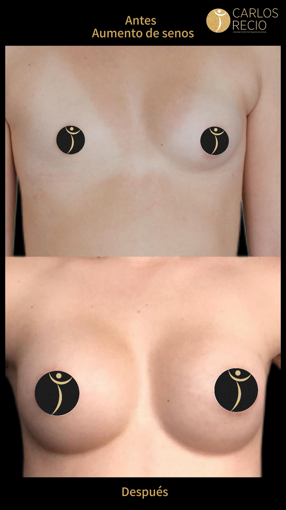 Aumento de senos en Cali IMG_3615