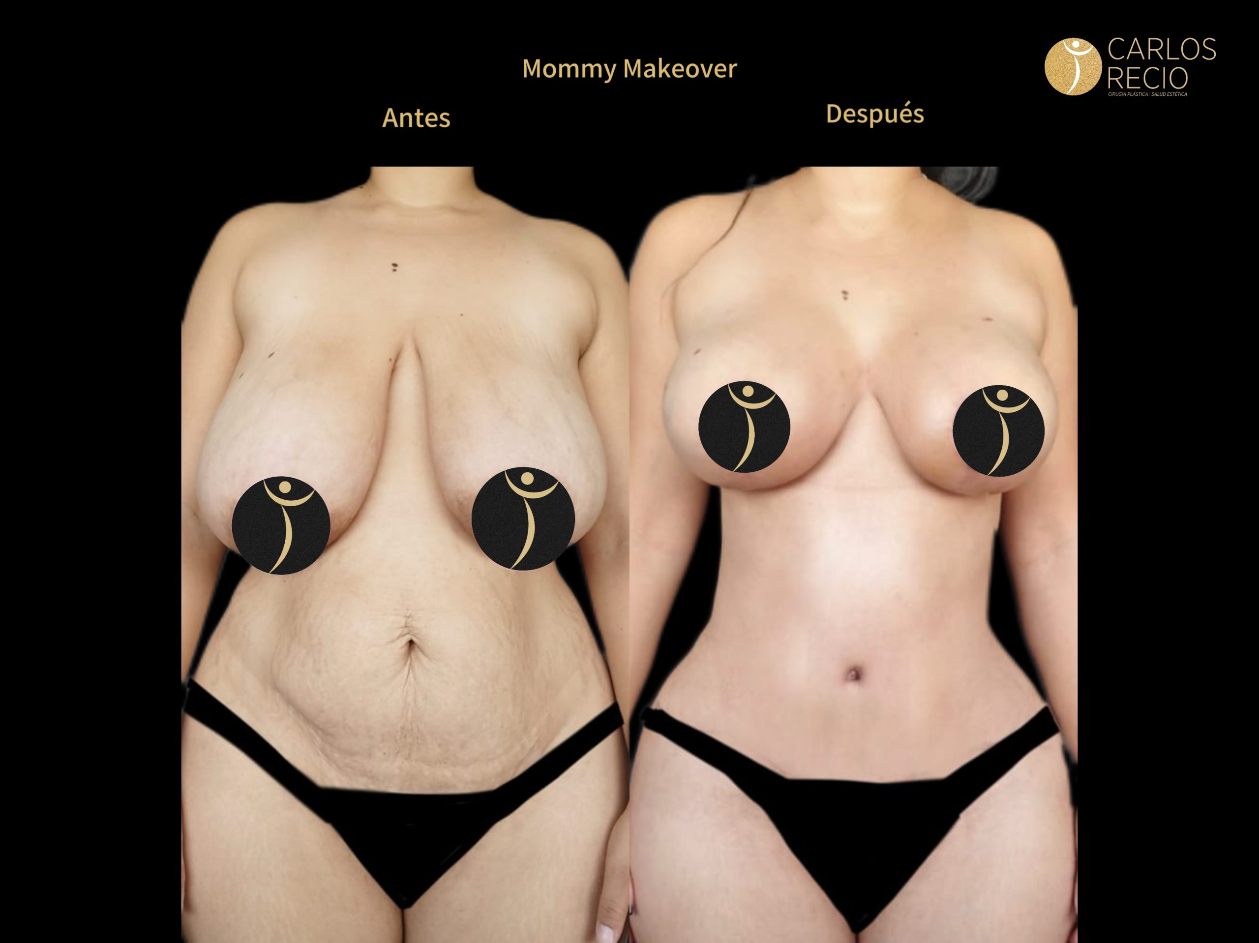 Mommy Makeover Mommy Makeover