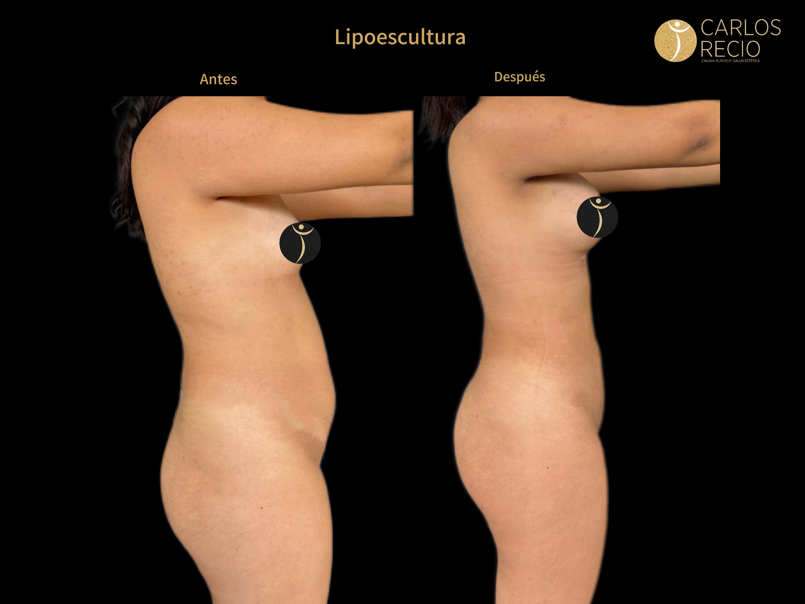 Lipoescultura IMG_3636