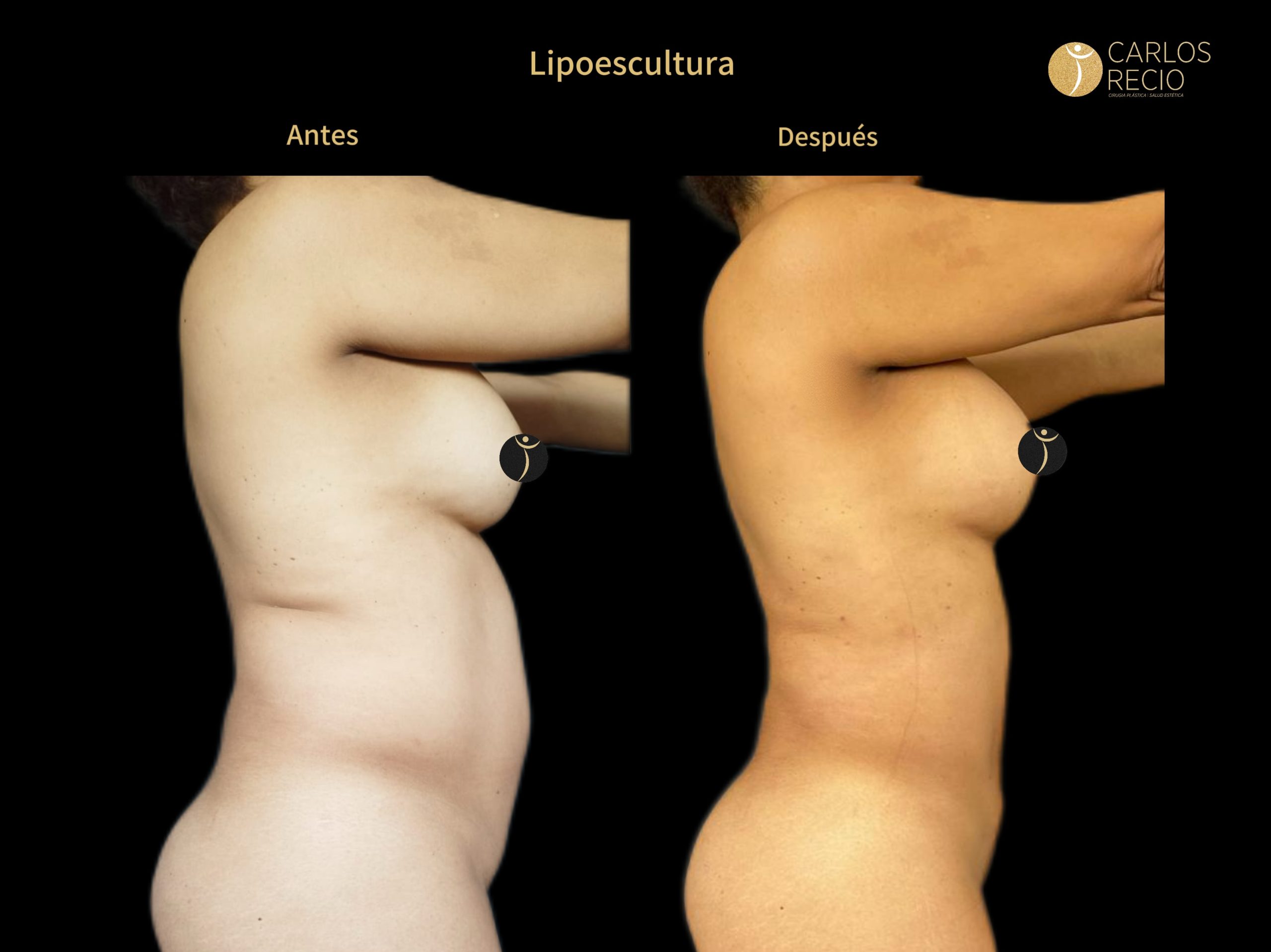 Lipoescultura IMG_3656