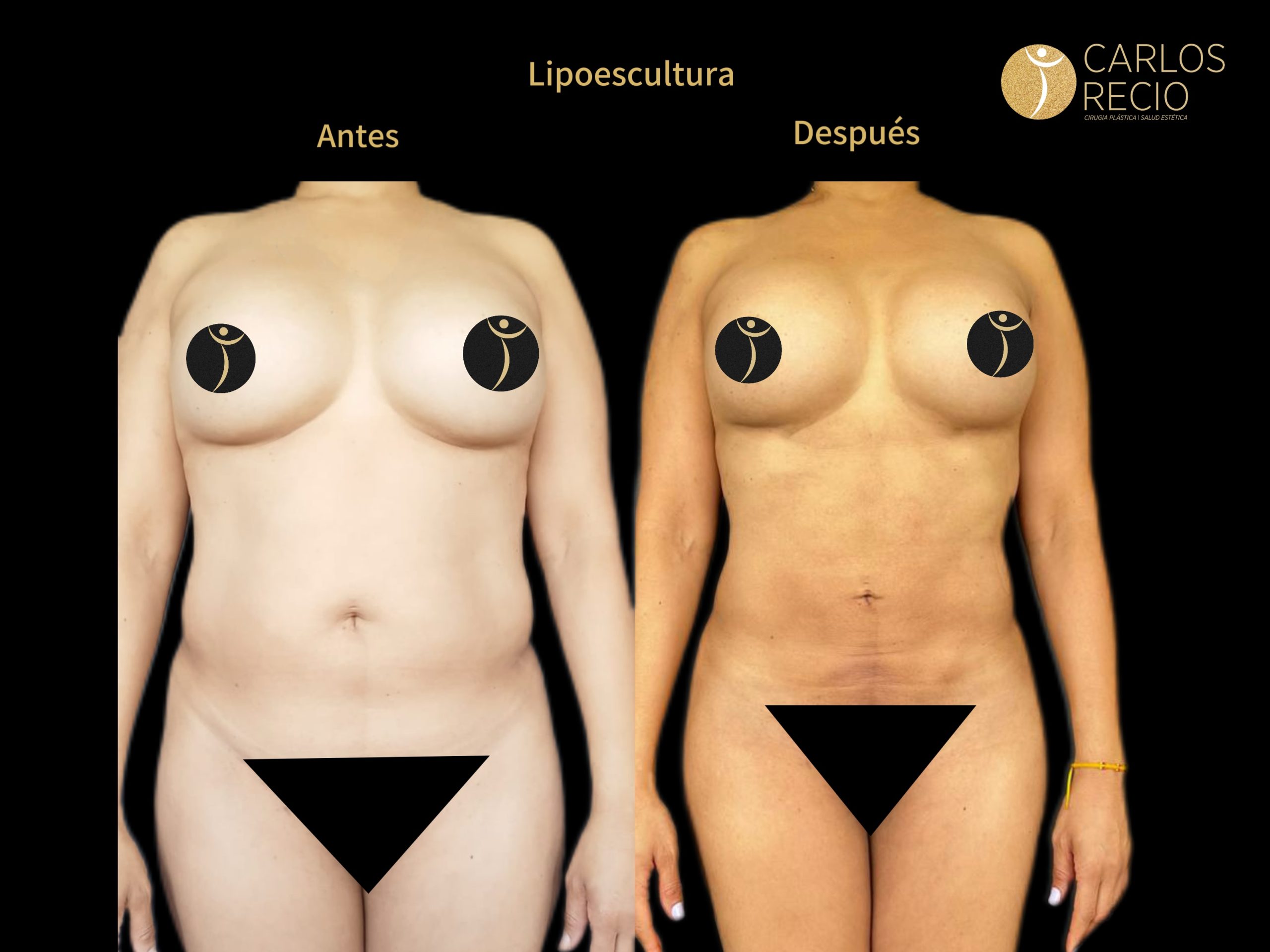 Lipoescultura IMG_3658