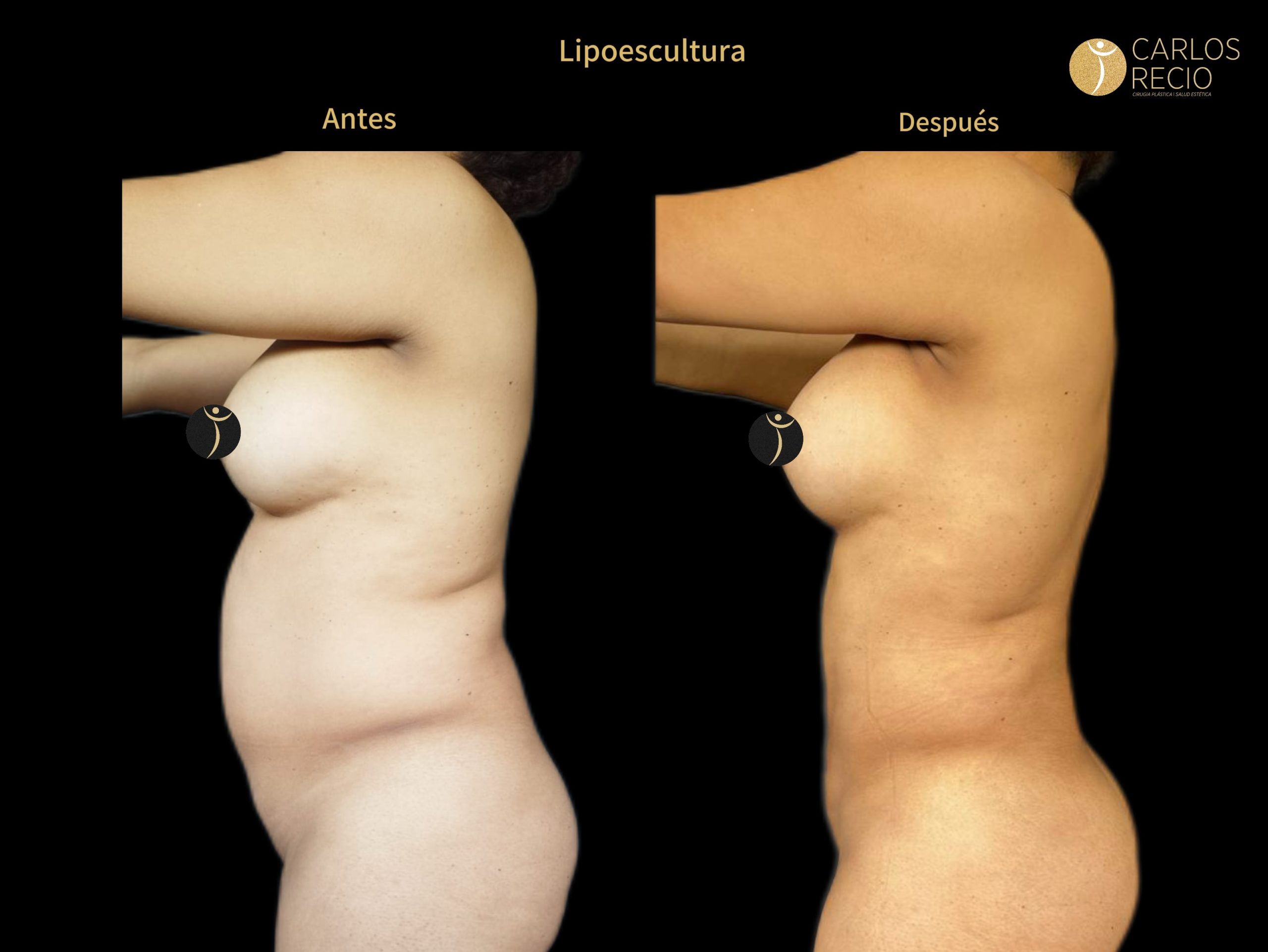 Lipoescultura IMG_3660