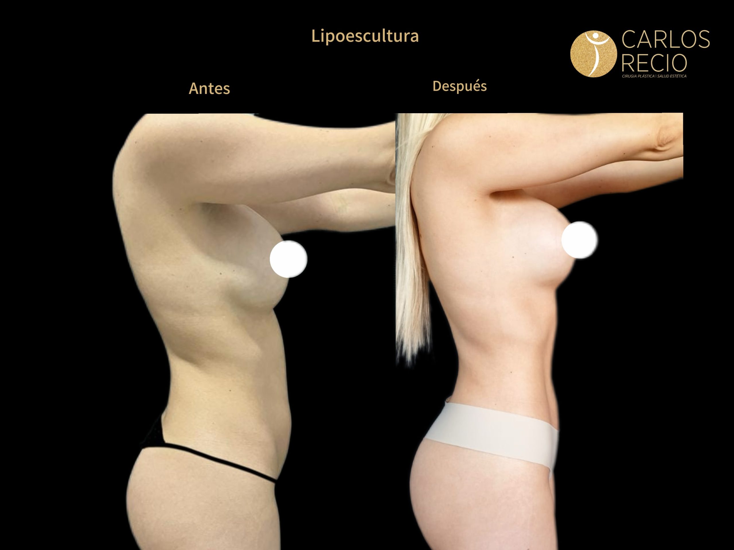 Lipoescultura IMG_3662