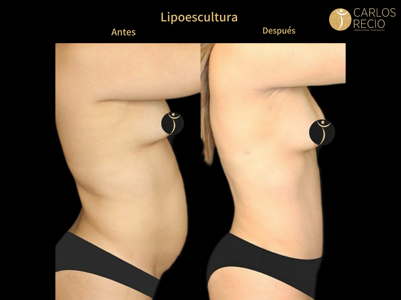 Lipoescultura IMG_3664