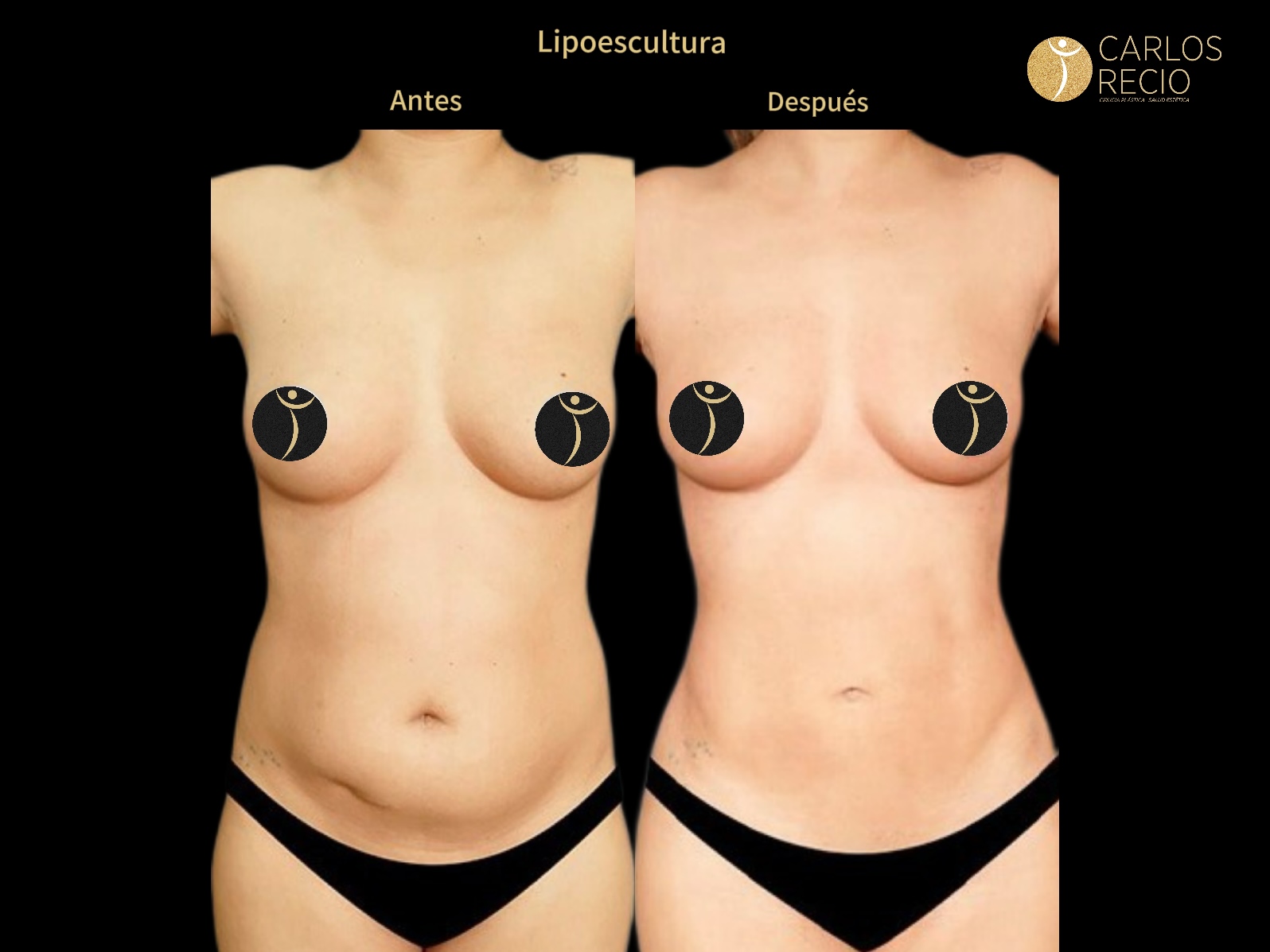 Lipoescultura IMG_3666