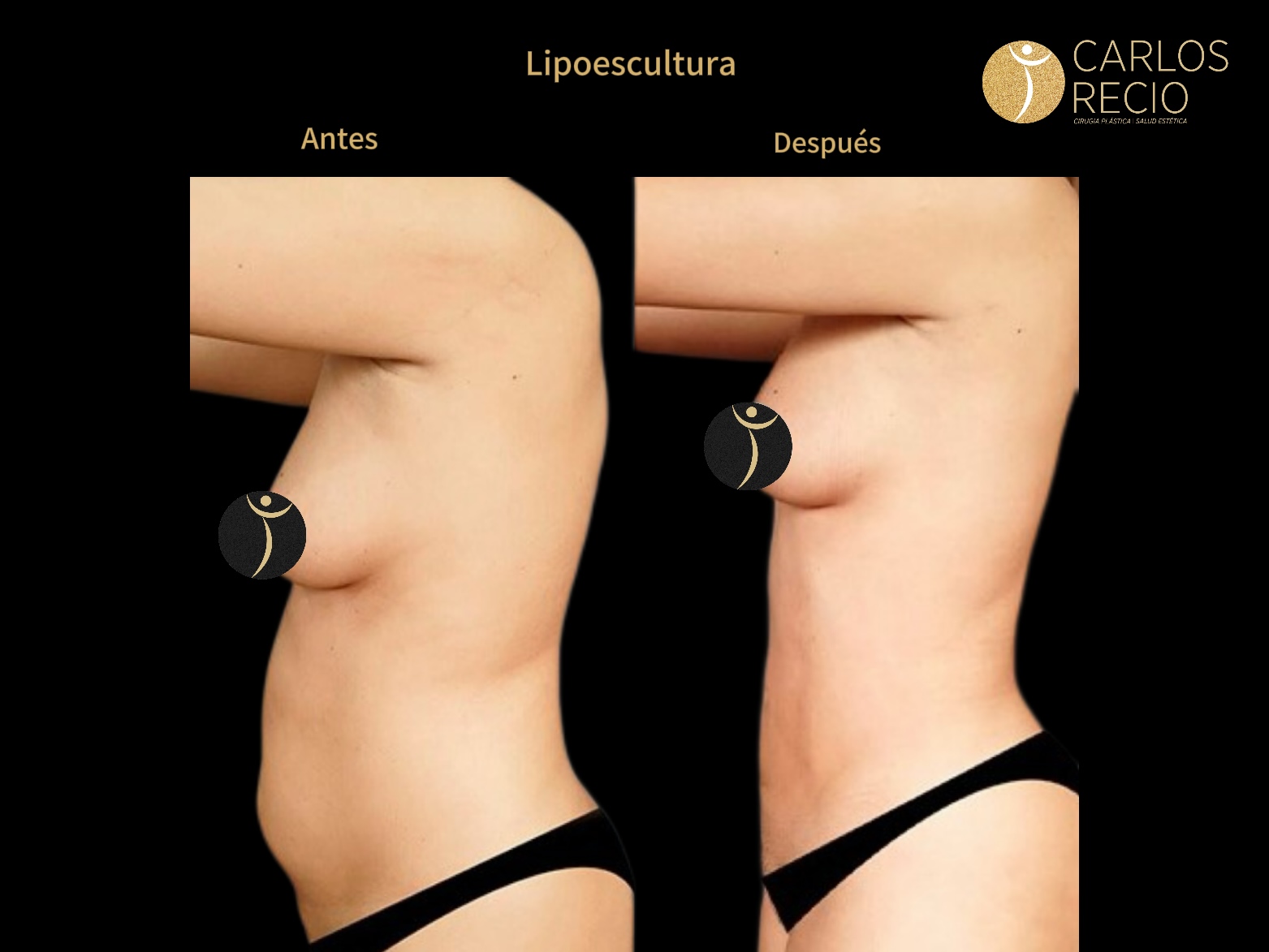 Lipoescultura IMG_3668