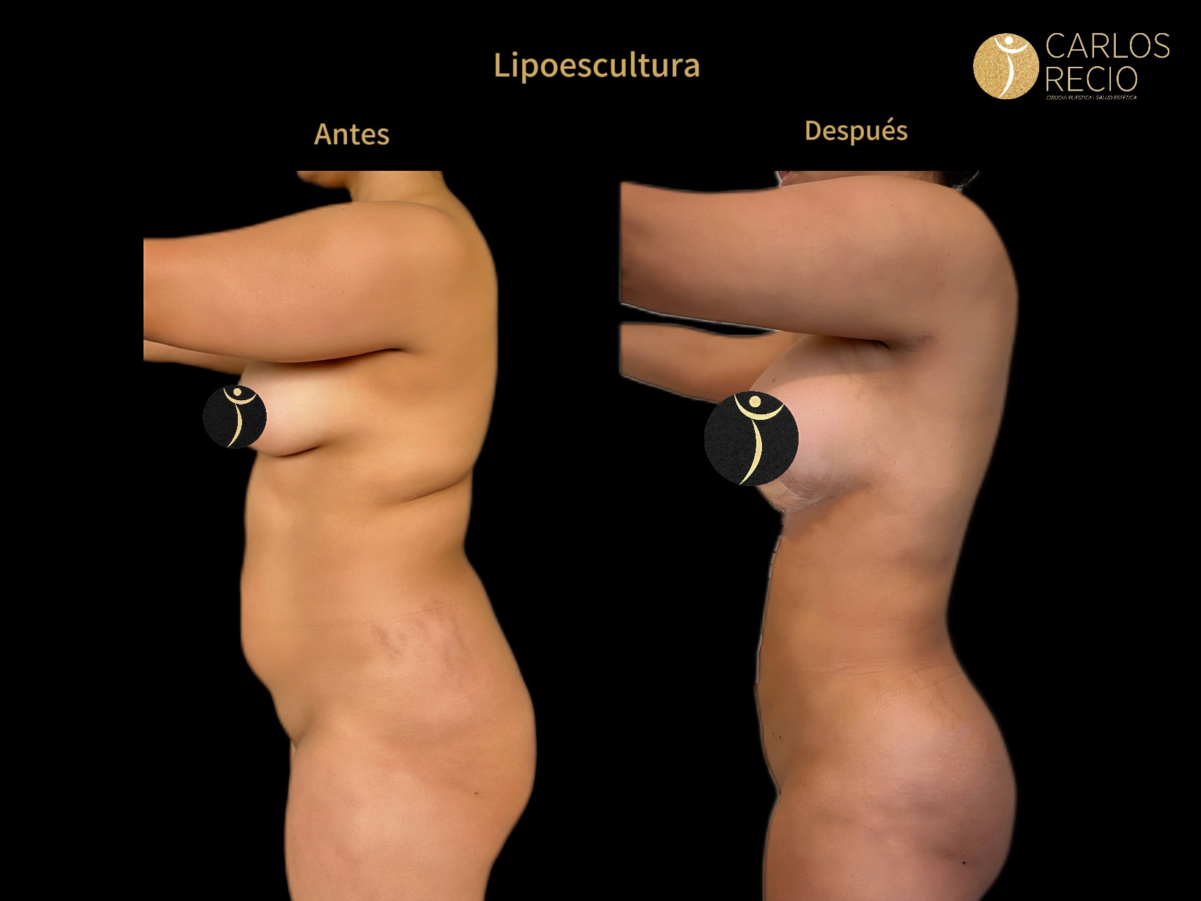 Lipoescultura IMG_3673