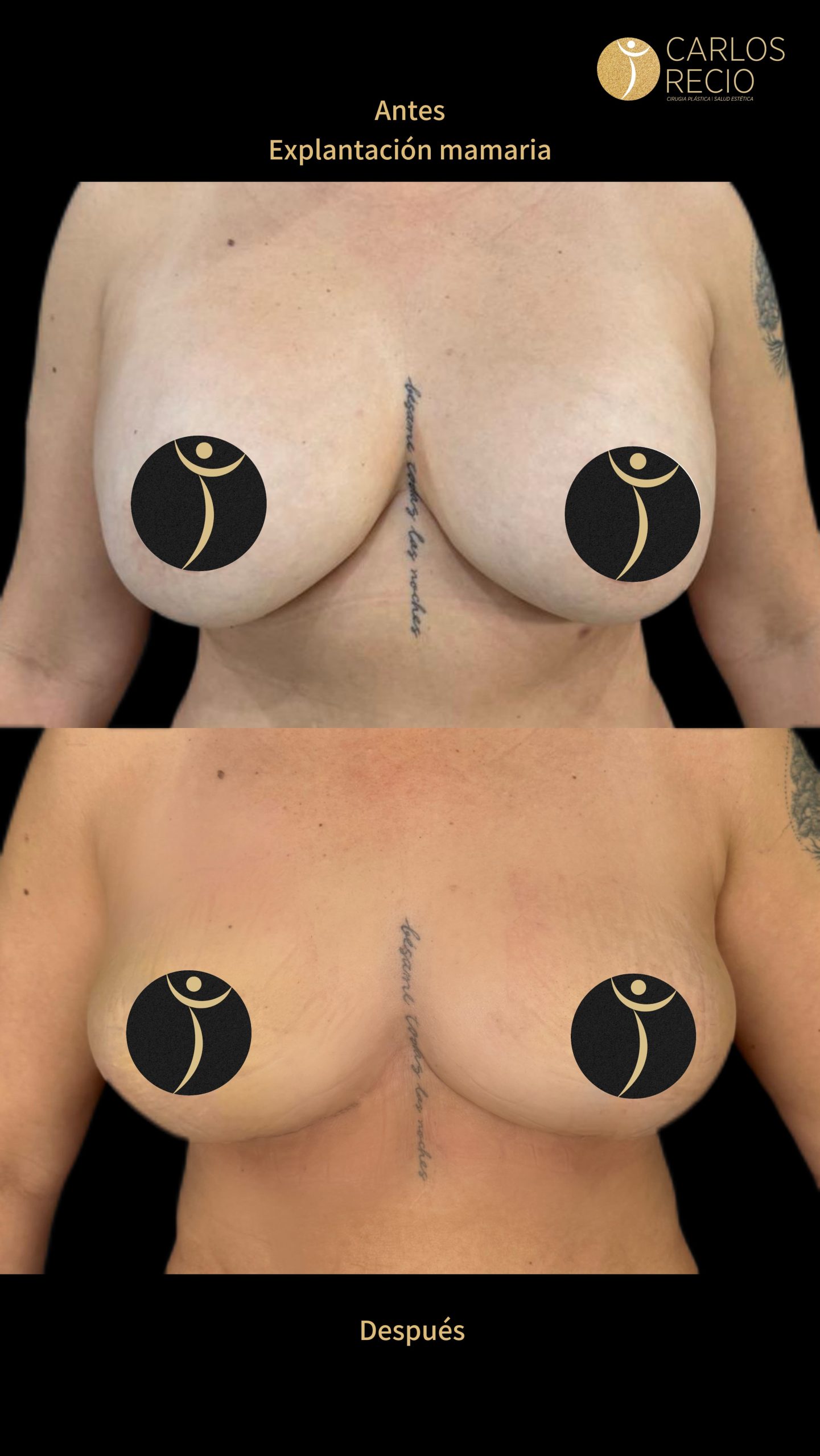 Explantación Mamaria en Cali IMG_3675