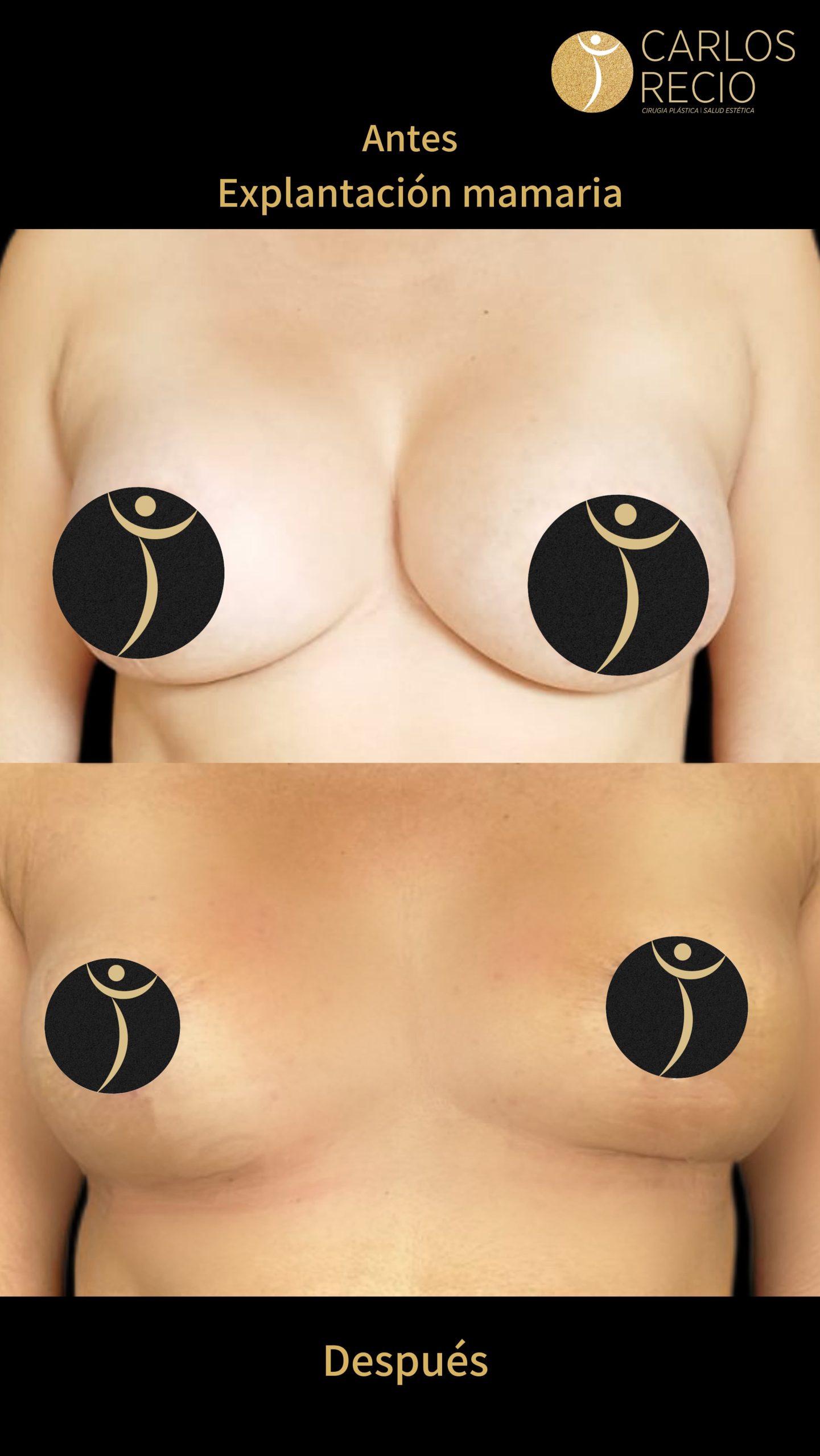 Explantación Mamaria en Cali IMG_3677